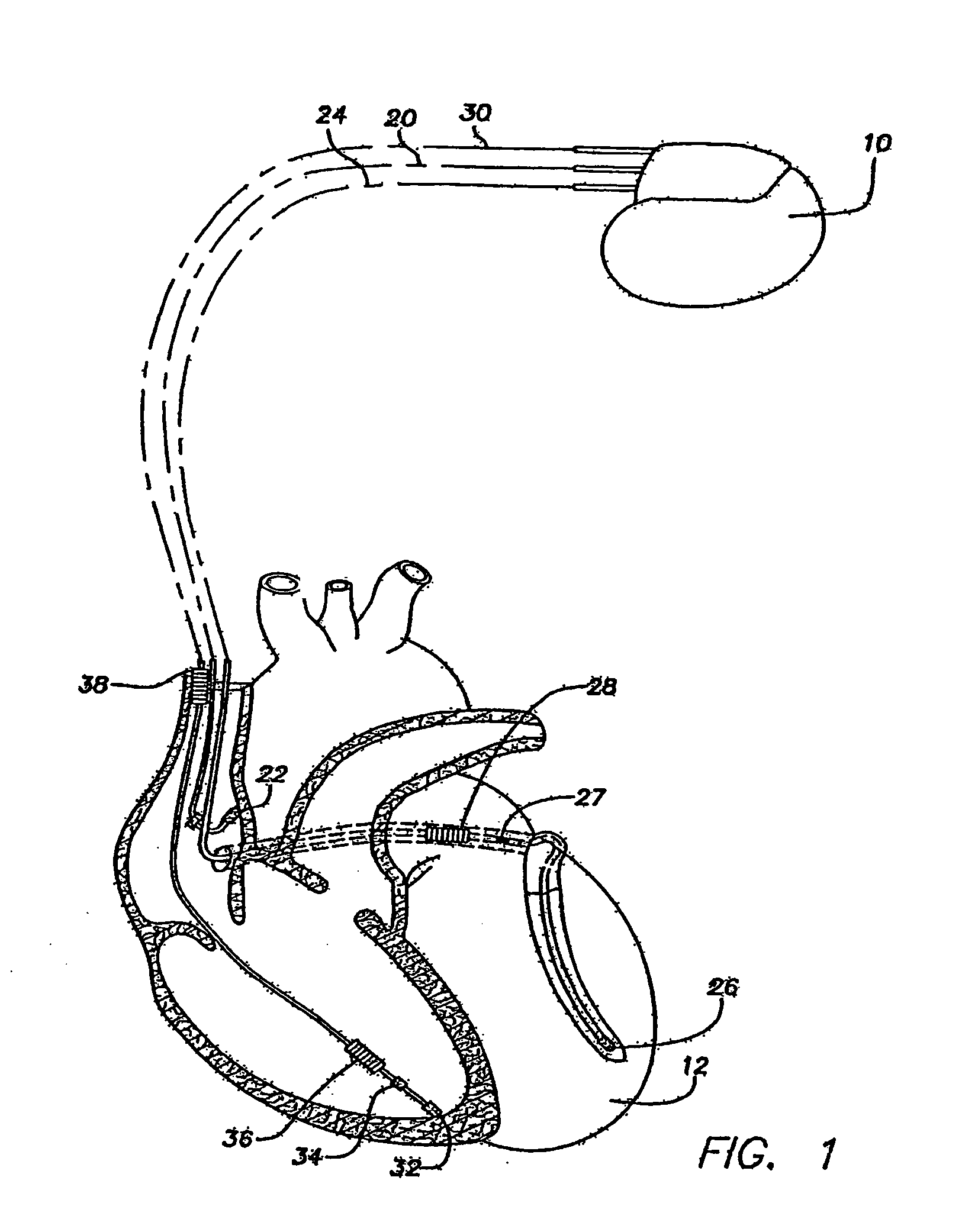 Methods and systems for detecting the presence of T-wave alternans