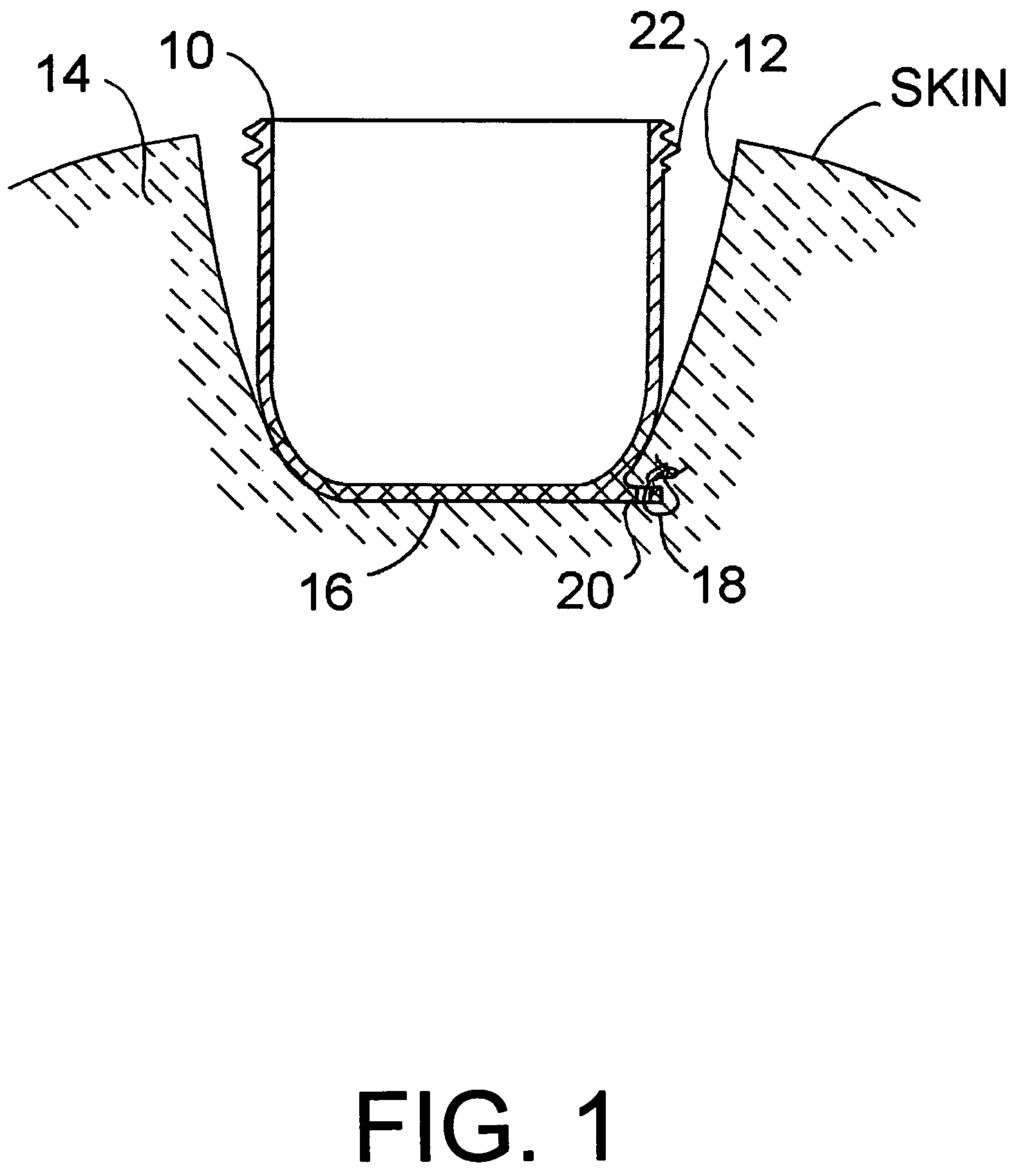 Applicators and methods for intraoperative treatment of proliferative diseases of the breast