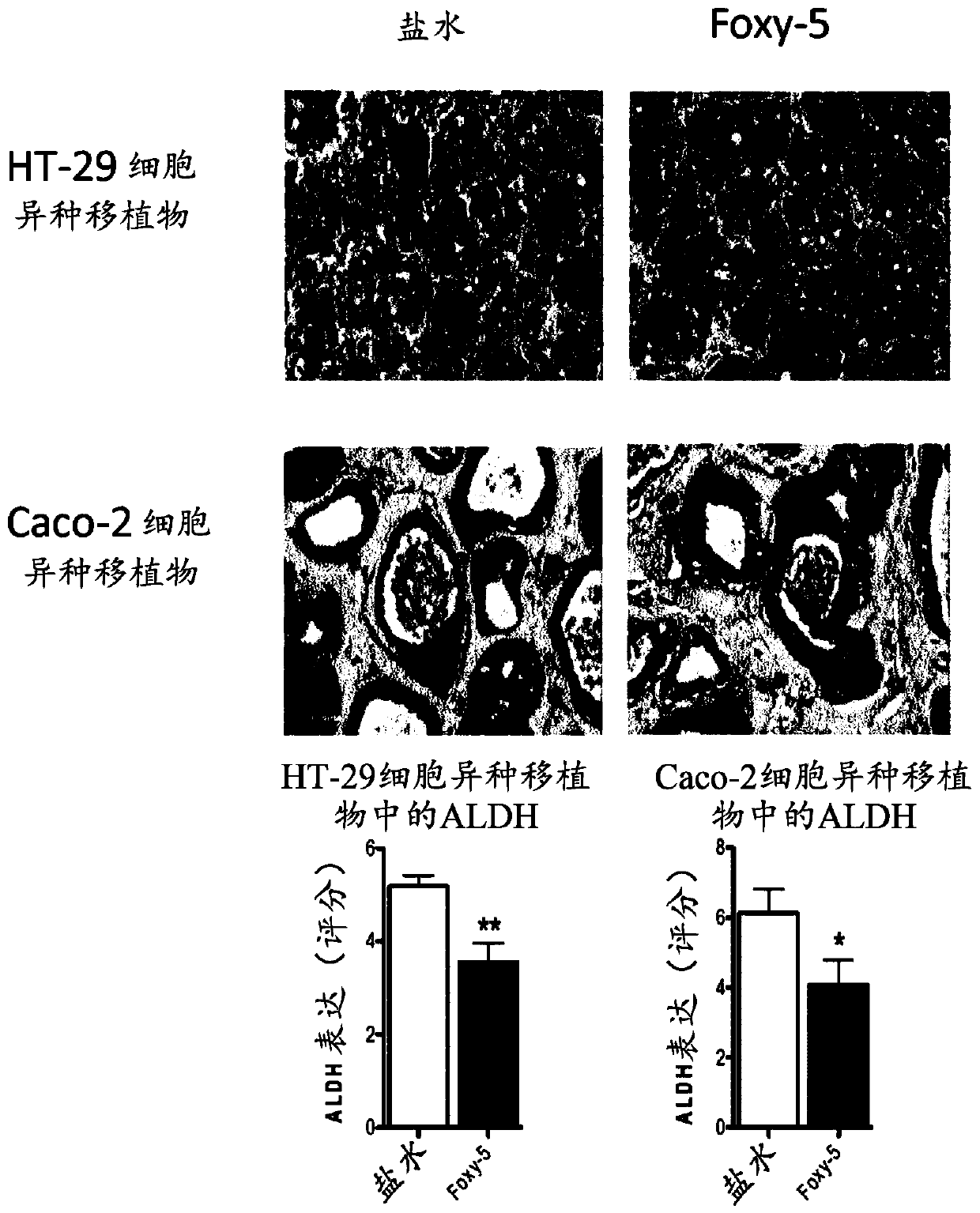Wnt5a peptides in reduction of cancer stem cells