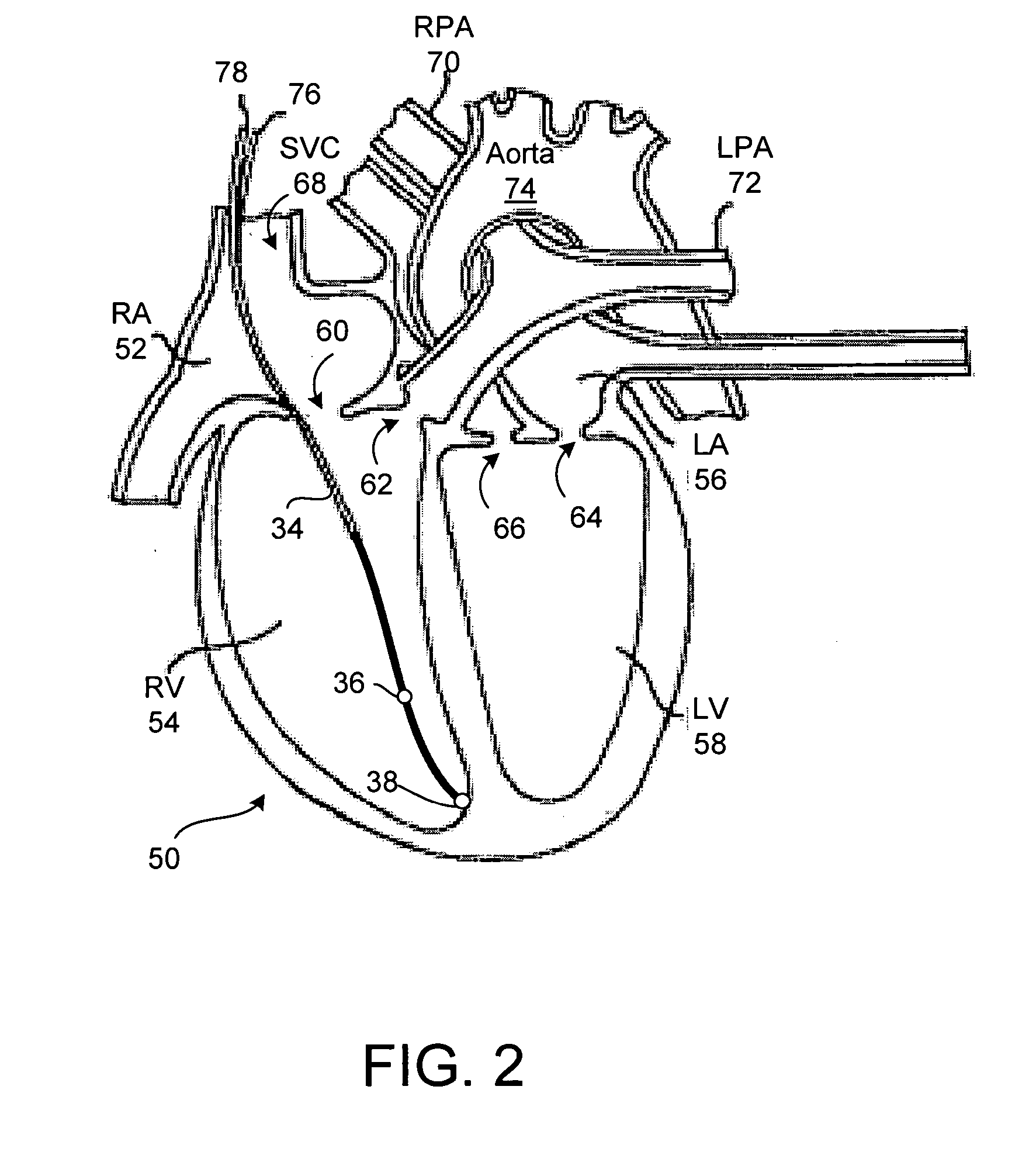 Implantable drug delivery system responsive to intra-cardiac pressure