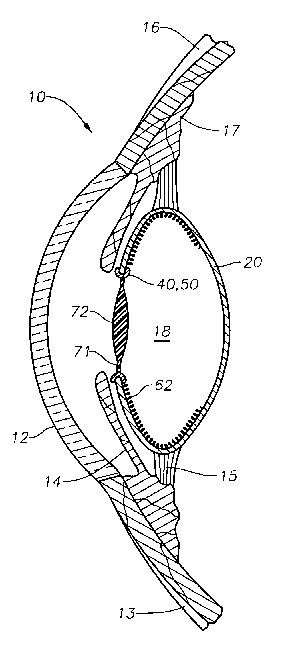 Intracapsular pseudophakic device