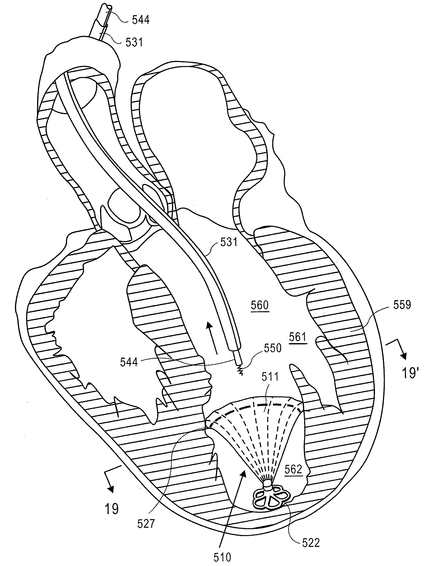 Retrievable devices for improving cardiac function