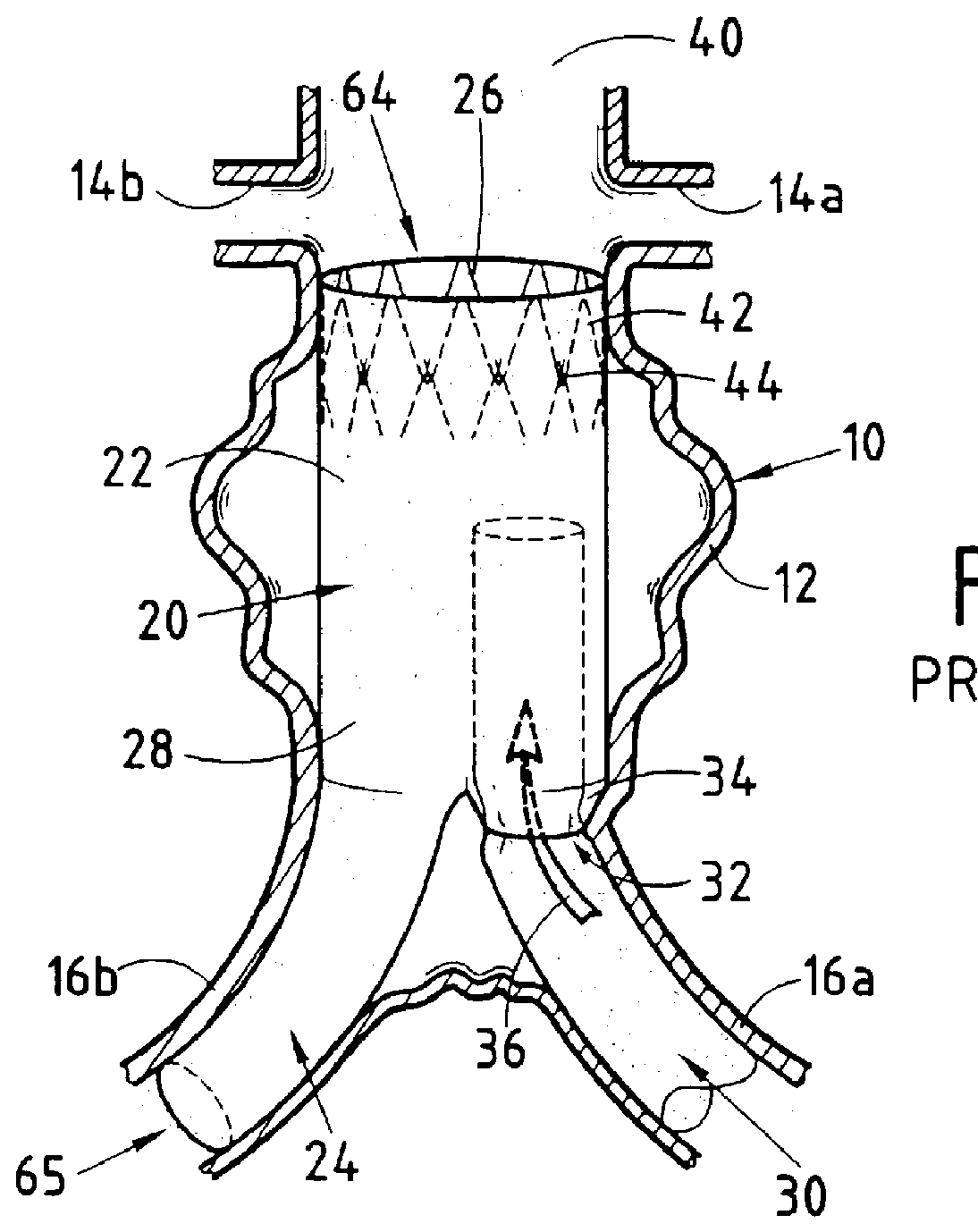 Device forming an endoluminal intracorporeal endoprosthesis, in particular for the abdominal aorta