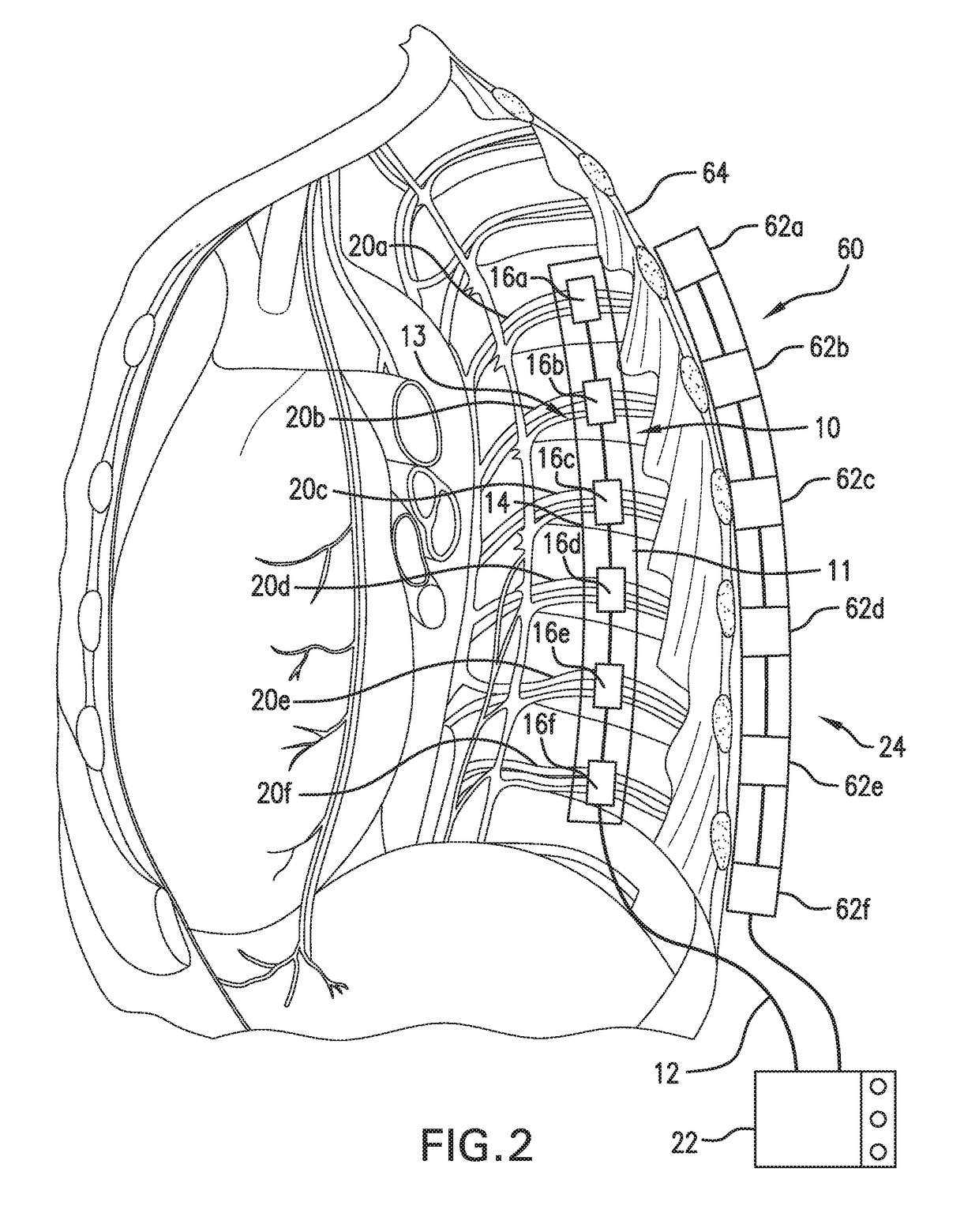 Implantable temporary nerve conduction blocking method and system