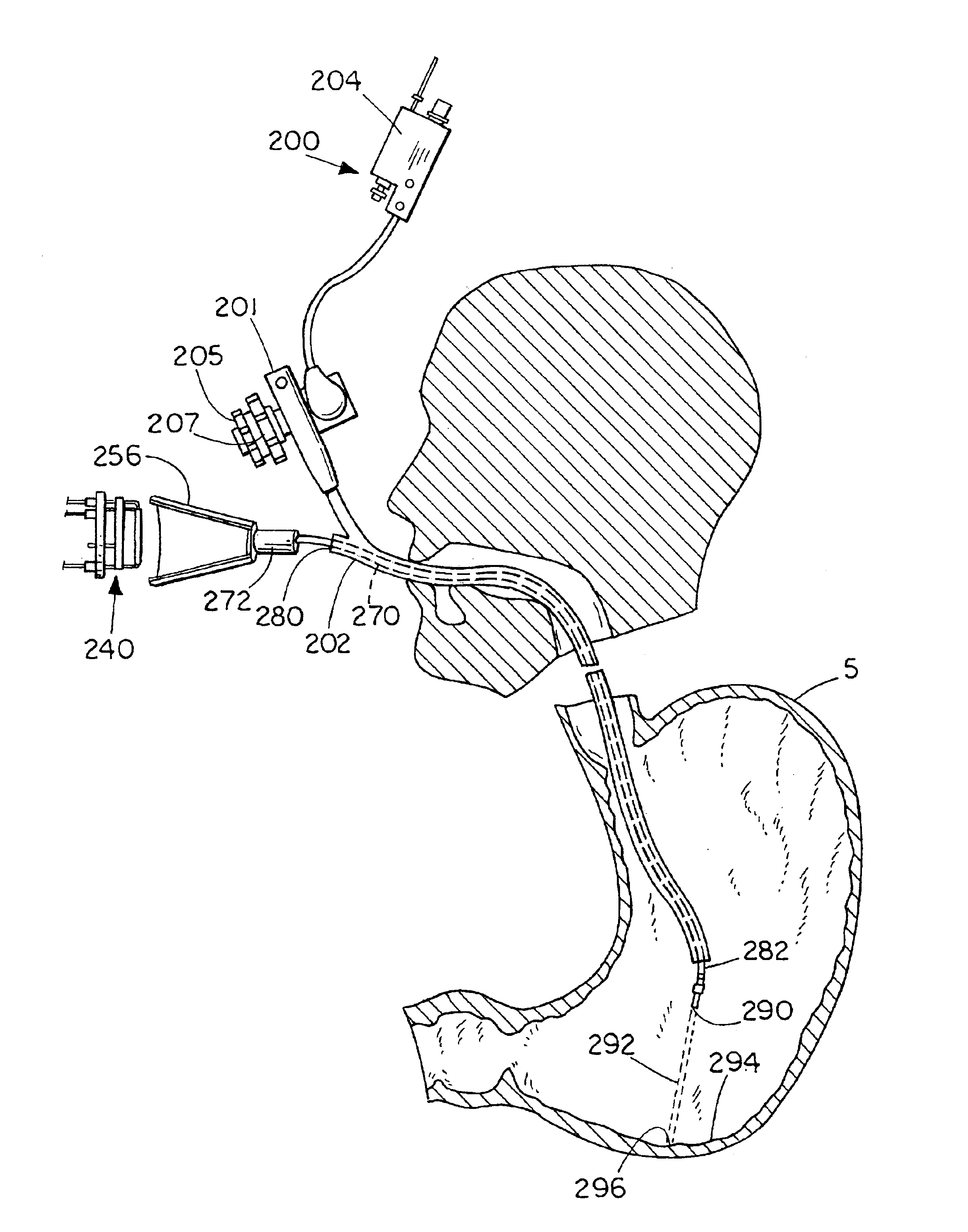 Apparatus and method for debilitating or killing microorganisms within the body