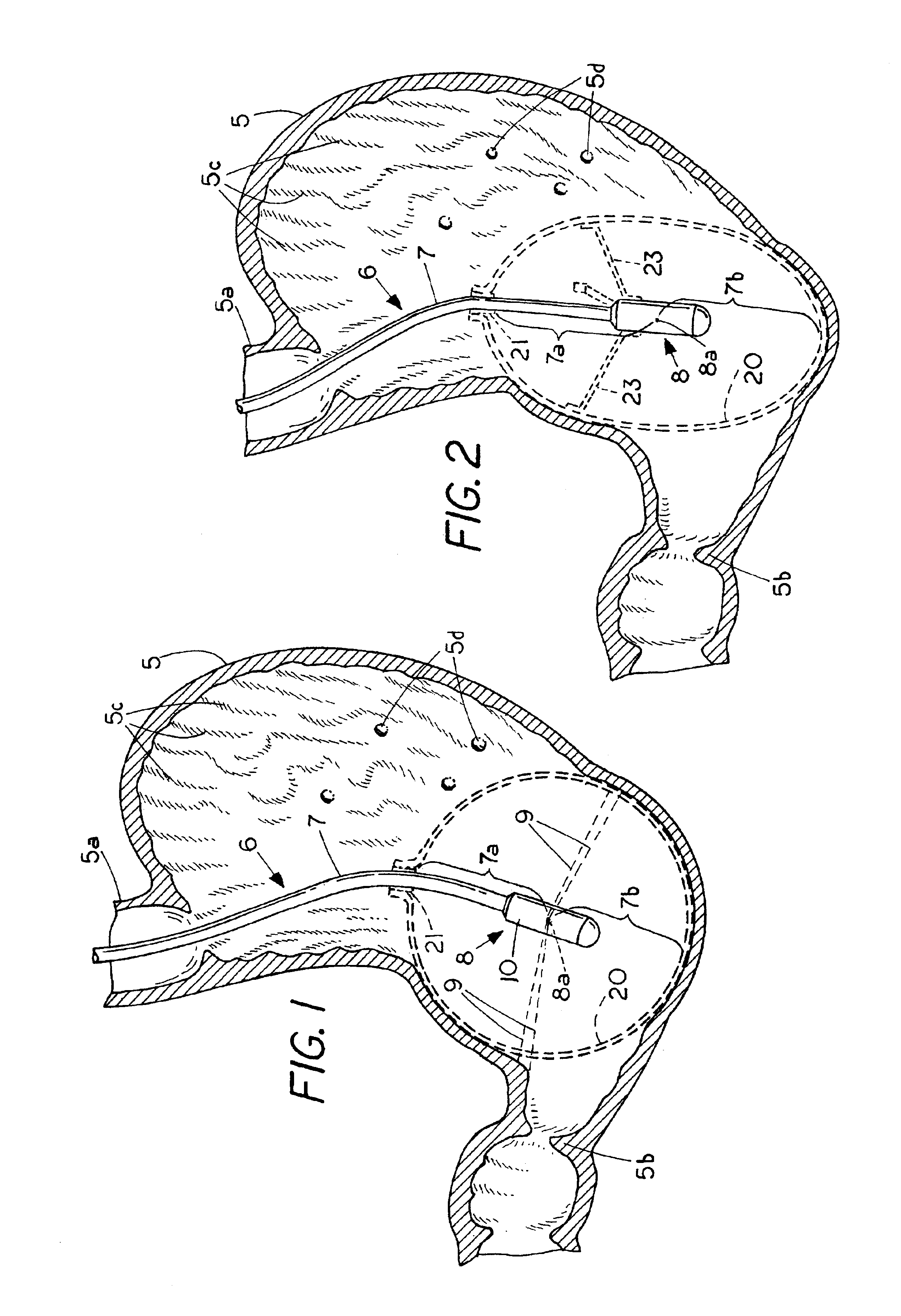 Apparatus and method for debilitating or killing microorganisms within the body