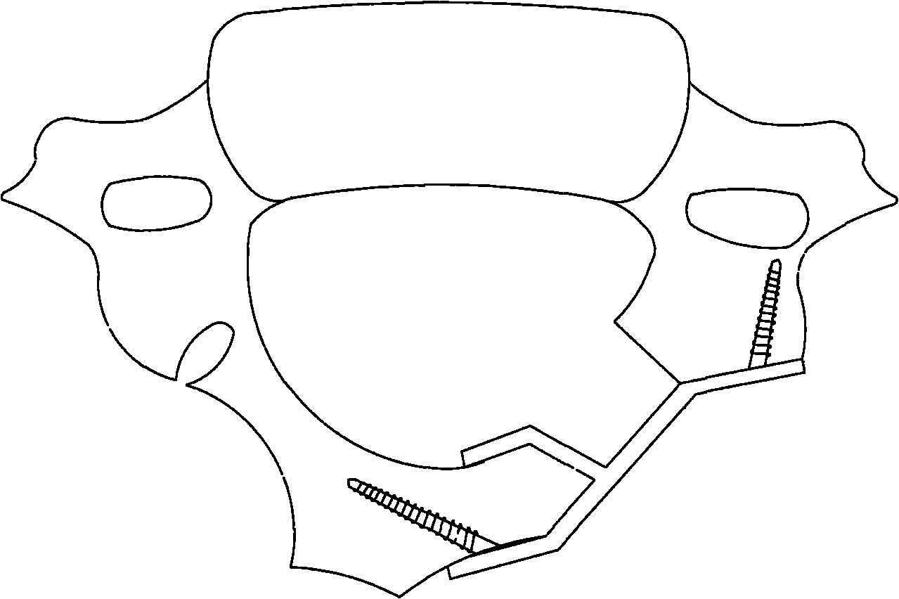 Bone fracture plate formed by a vertebral plate