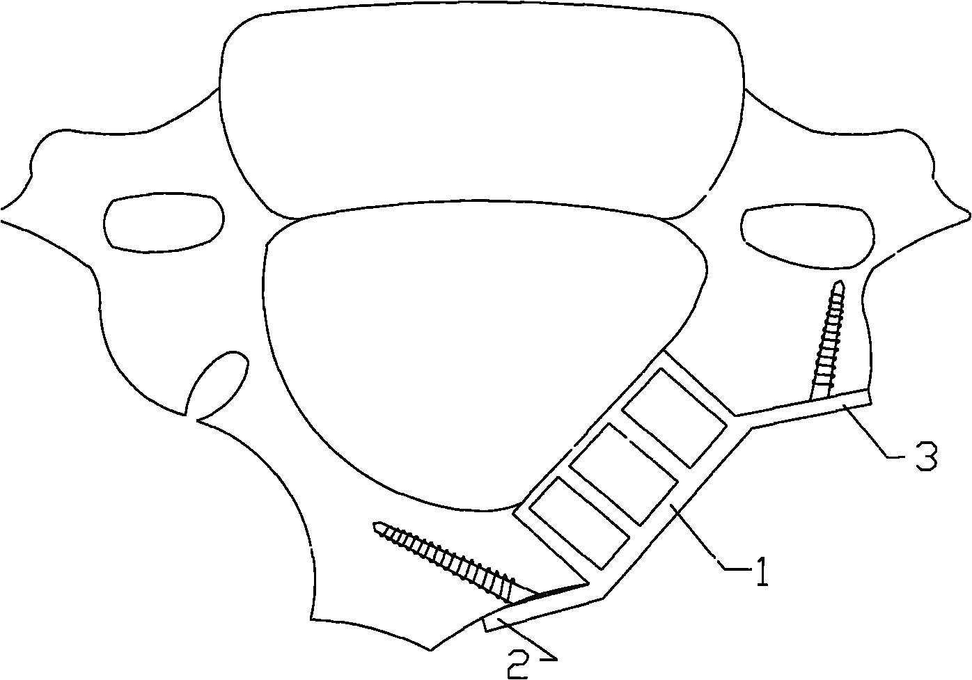 Bone fracture plate formed by a vertebral plate