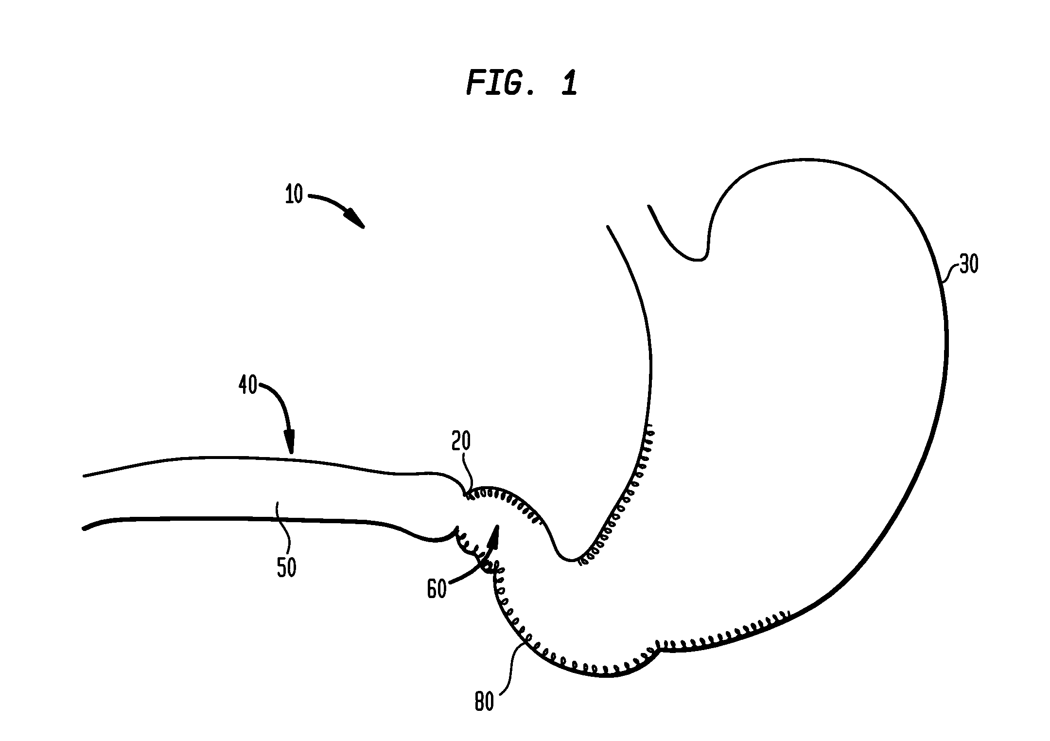 Systems and methods for treating obesity and type 2 diabetes
