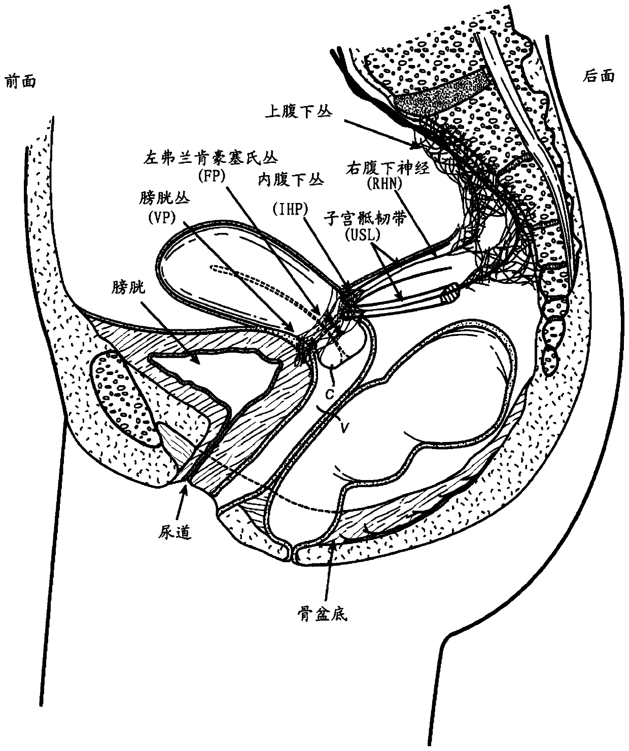 Devices and methods for stimulating nerves