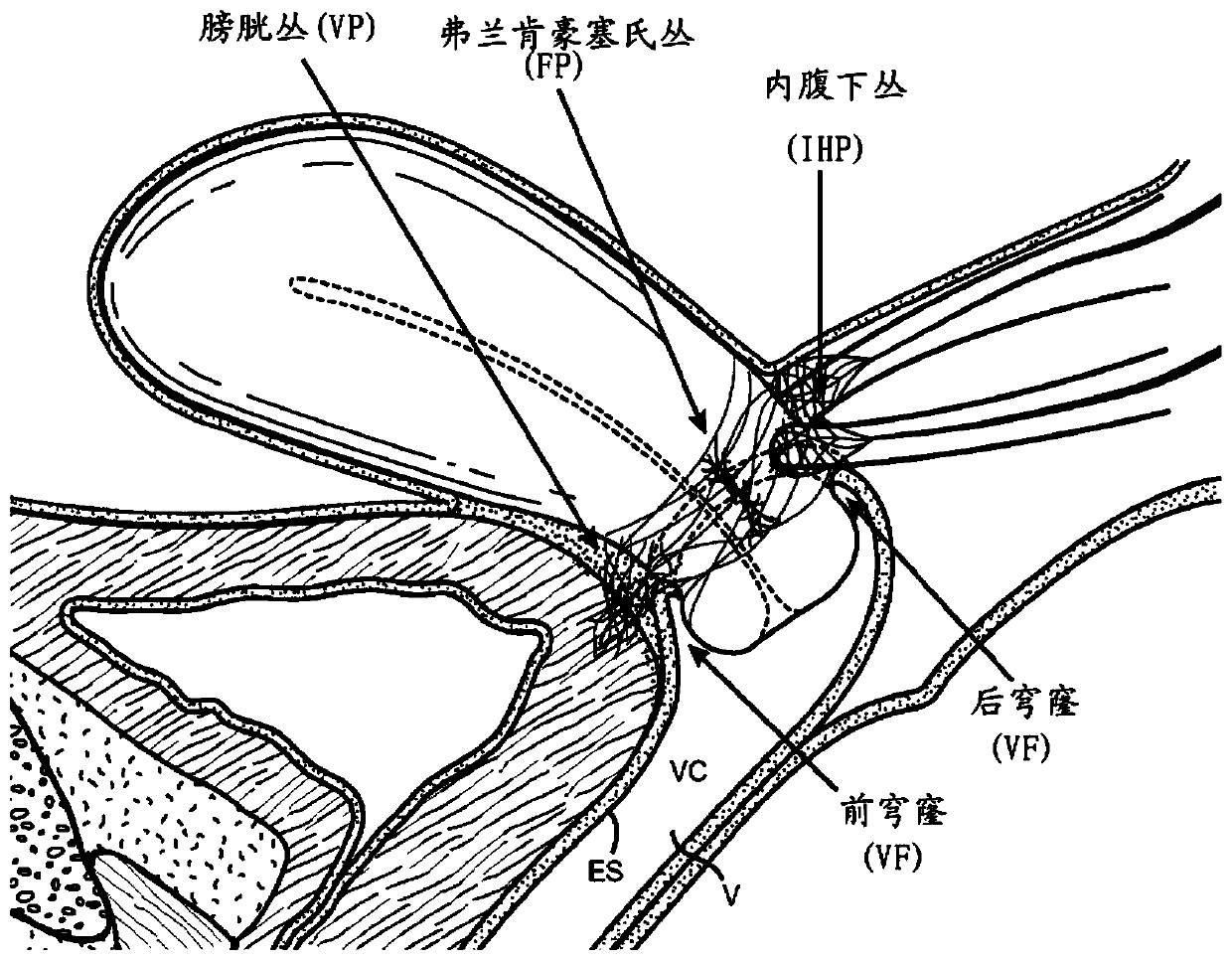 Devices and methods for stimulating nerves