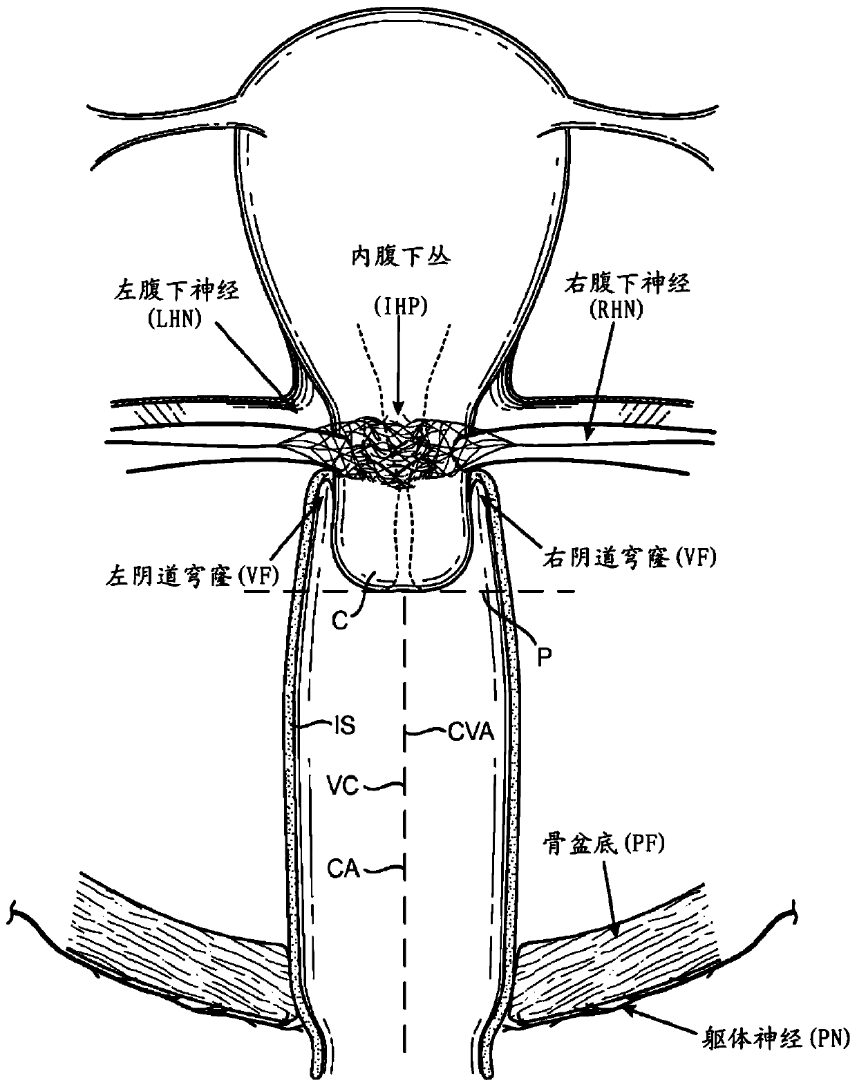 Devices and methods for stimulating nerves