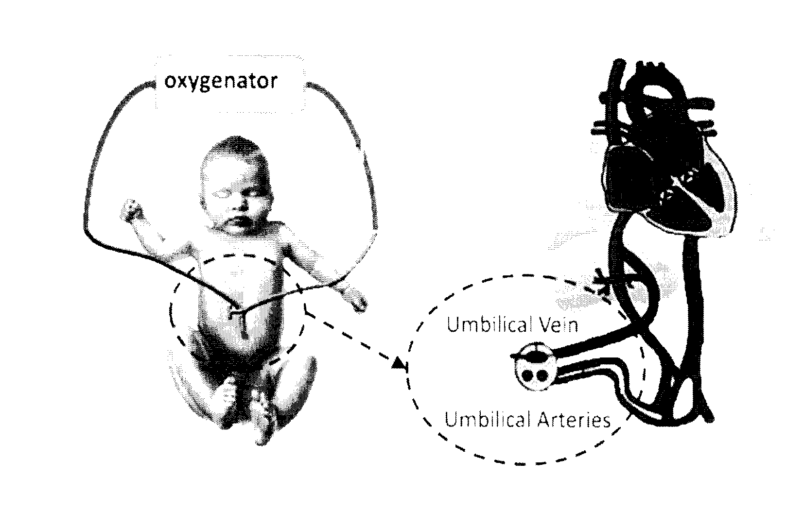 Artificial placenta