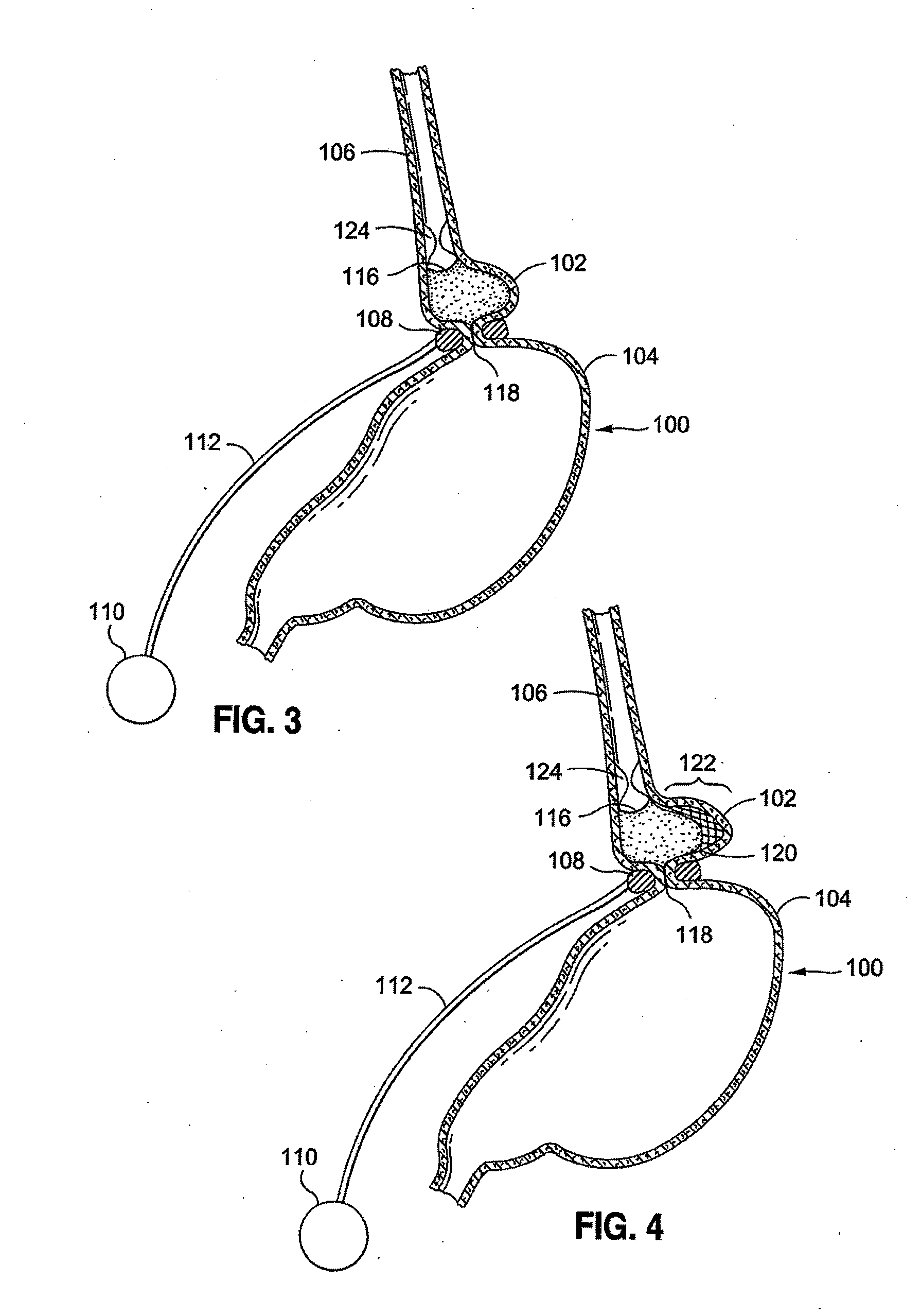 External sensing systems and methods for gastric restriction devices