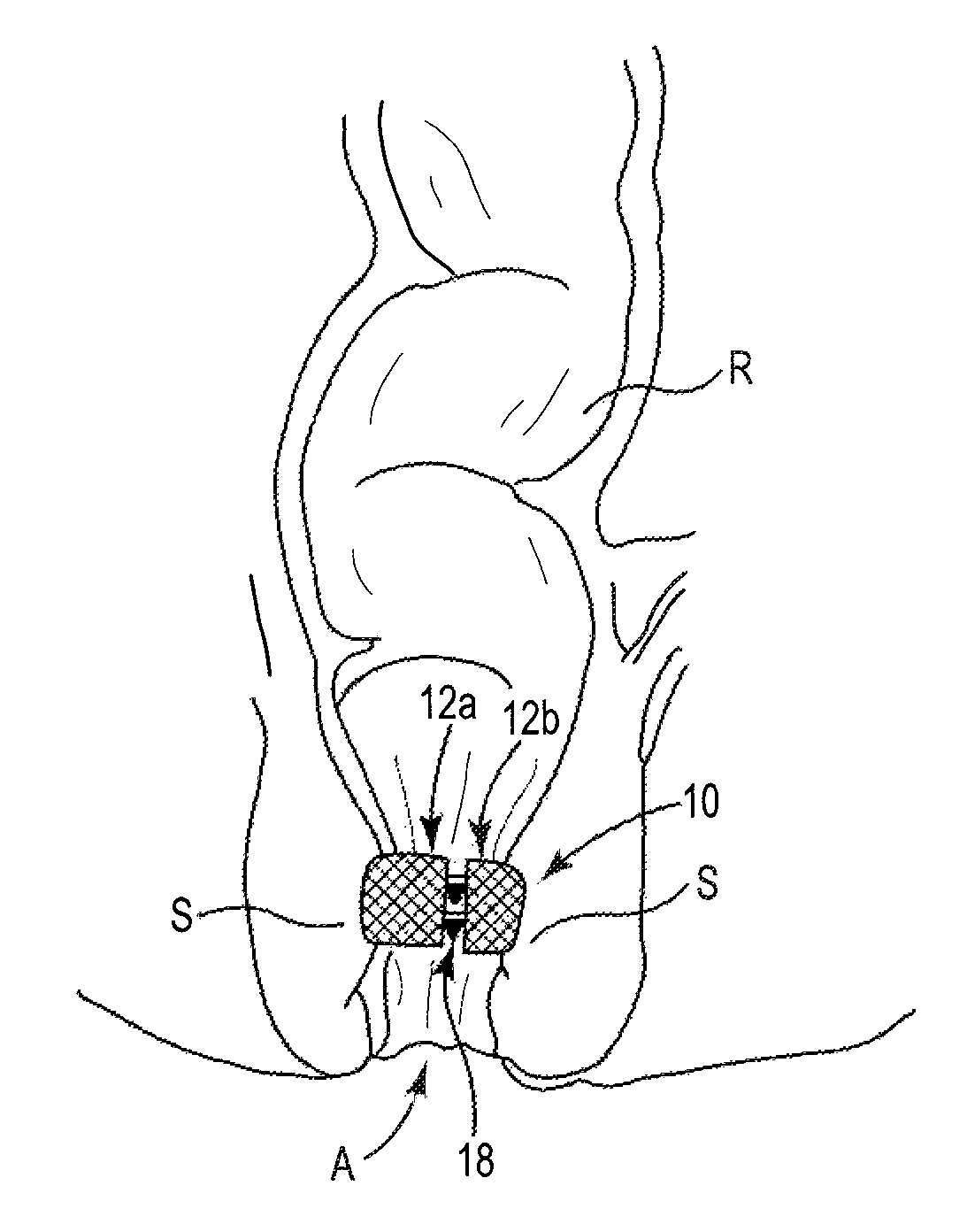 Fecal incontinence treatment device and method