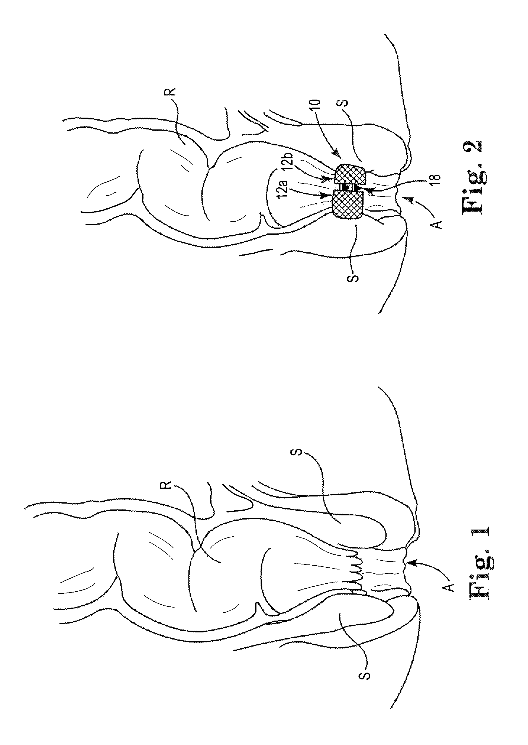 Fecal incontinence treatment device and method