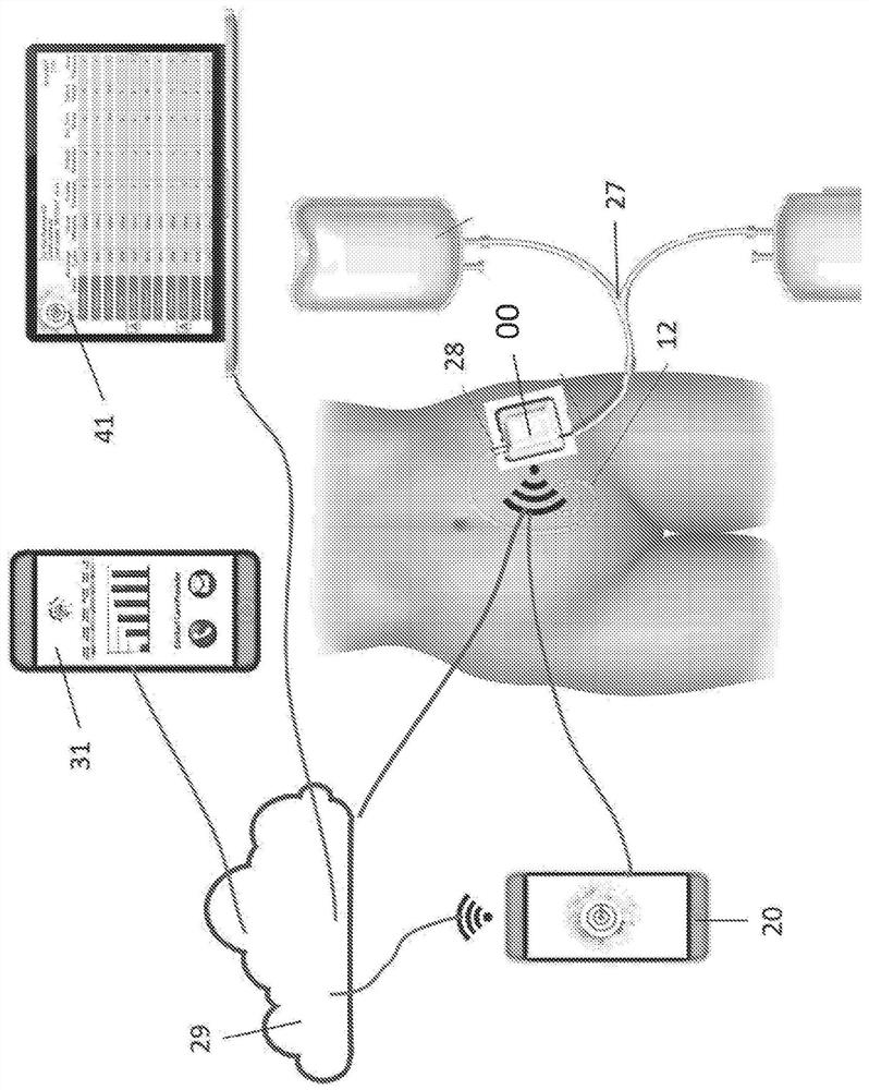 Sensor monitoring system for in-dwelling catheter based treatments