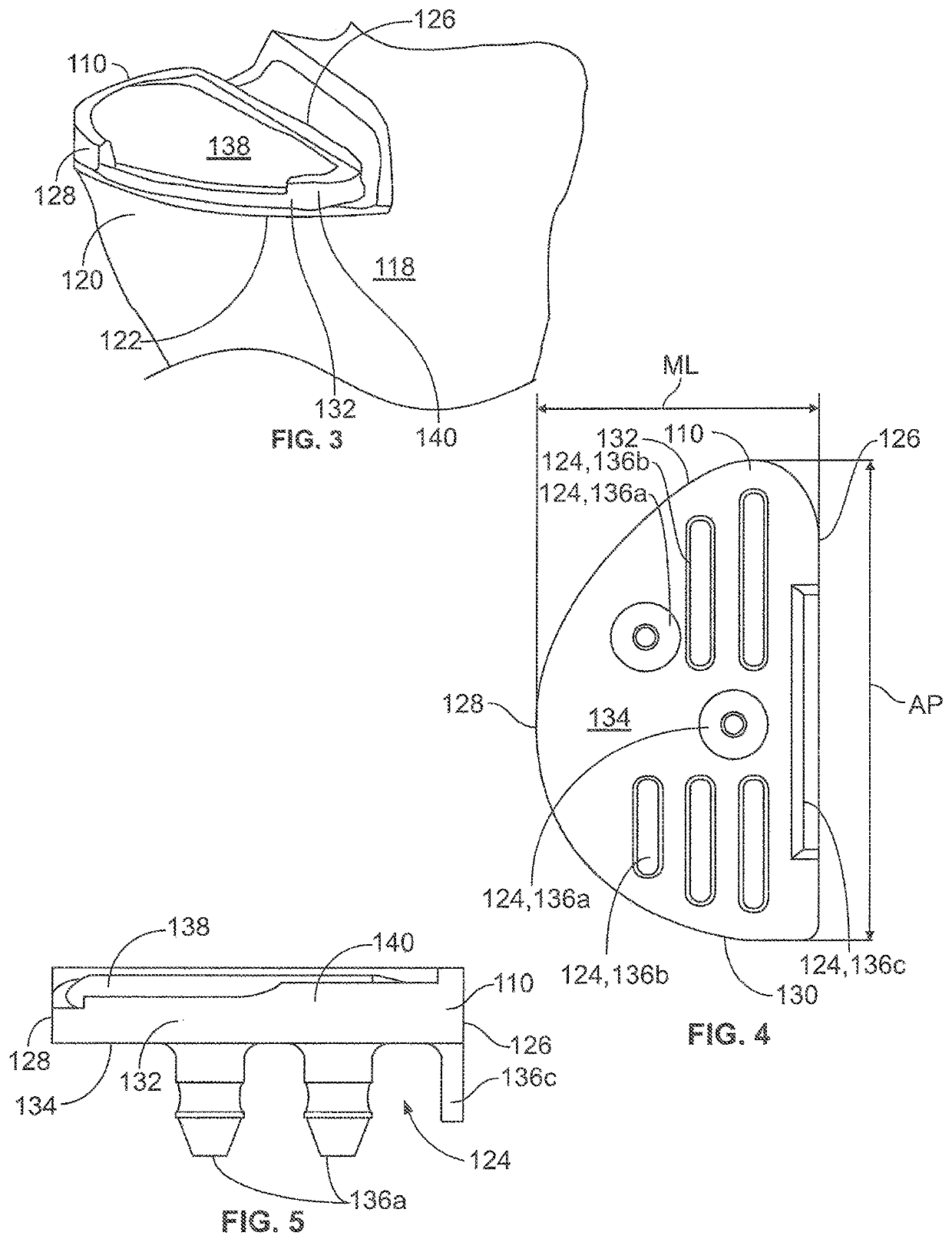 Unicondylar tibia implants