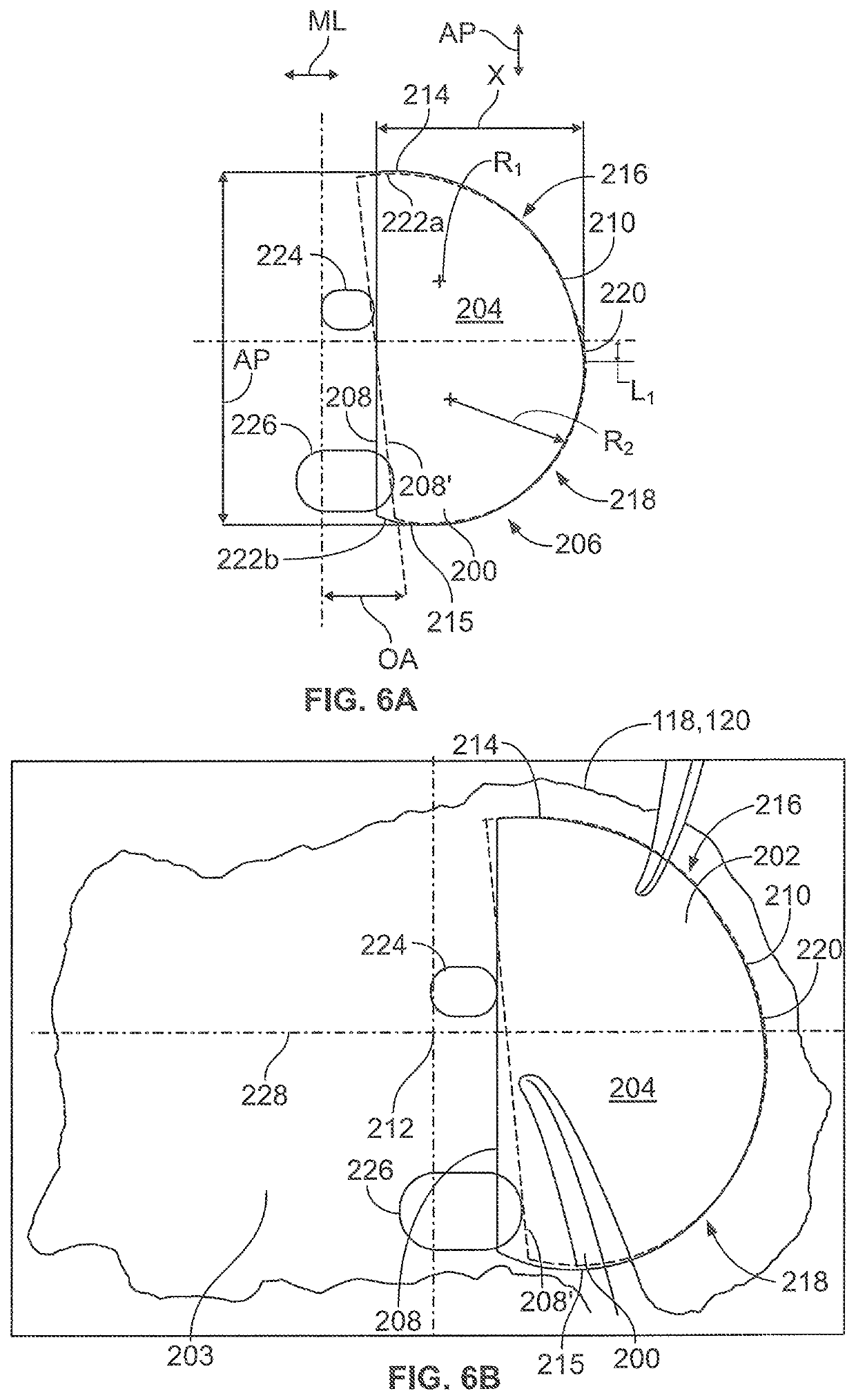 Unicondylar tibia implants