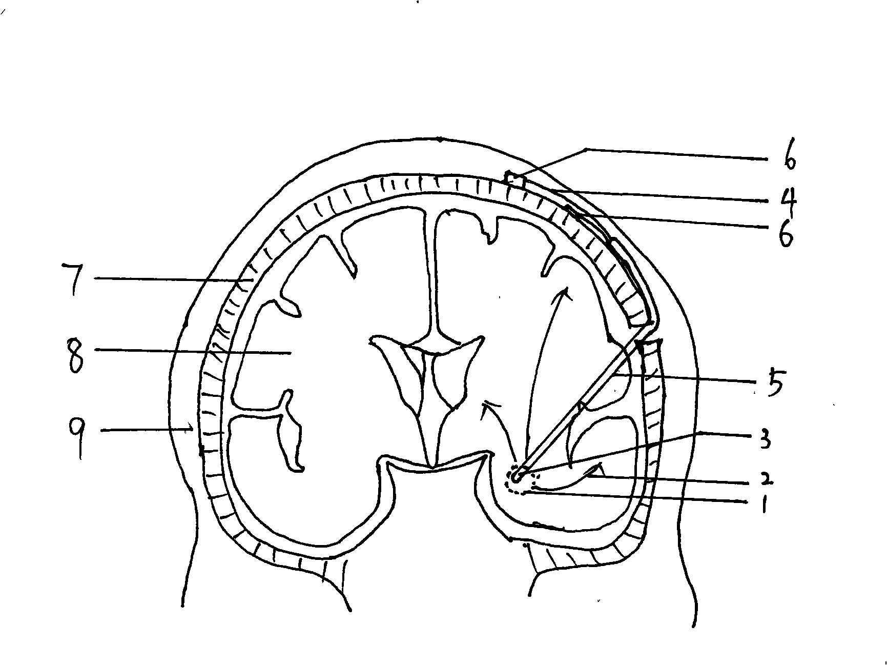 Deep brain epileptic discharge induction treatment method and equipment