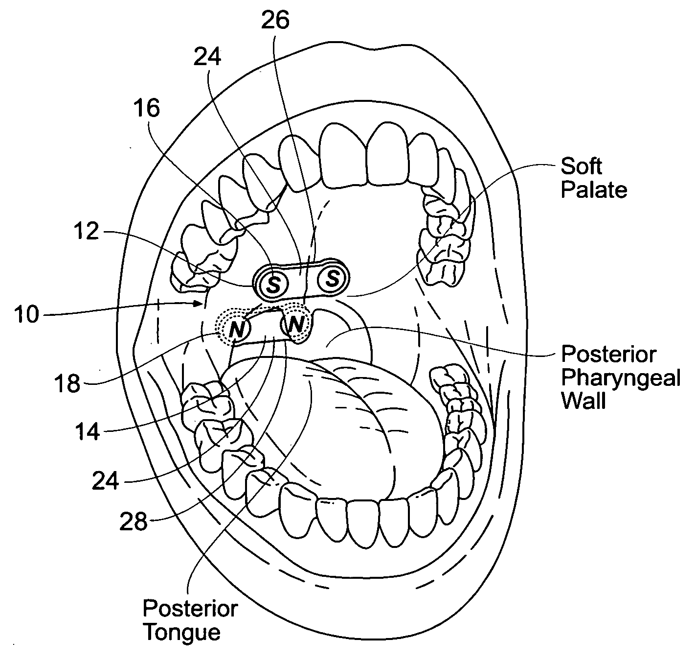 Devices, systems, and methods using magnetic force systems in or on tissue in an airway