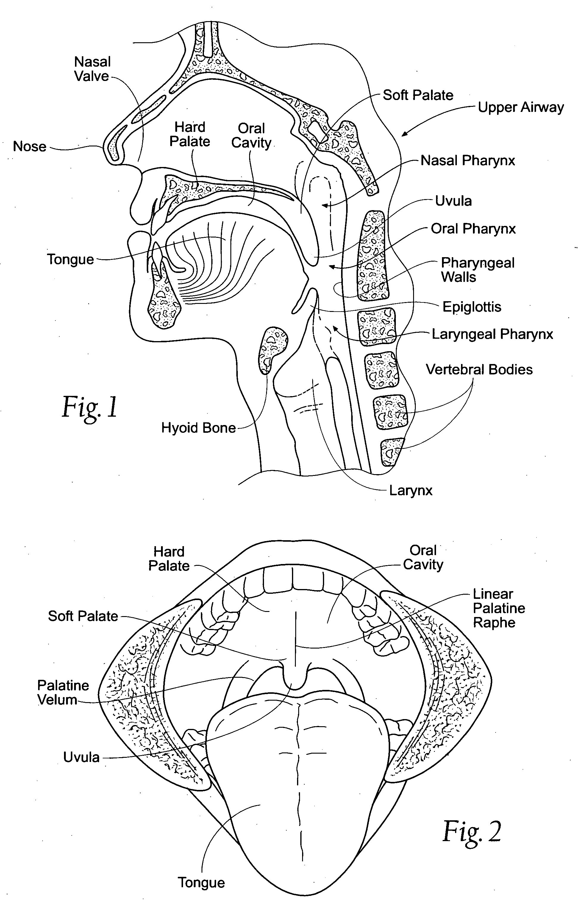 Devices, systems, and methods using magnetic force systems in or on tissue in an airway