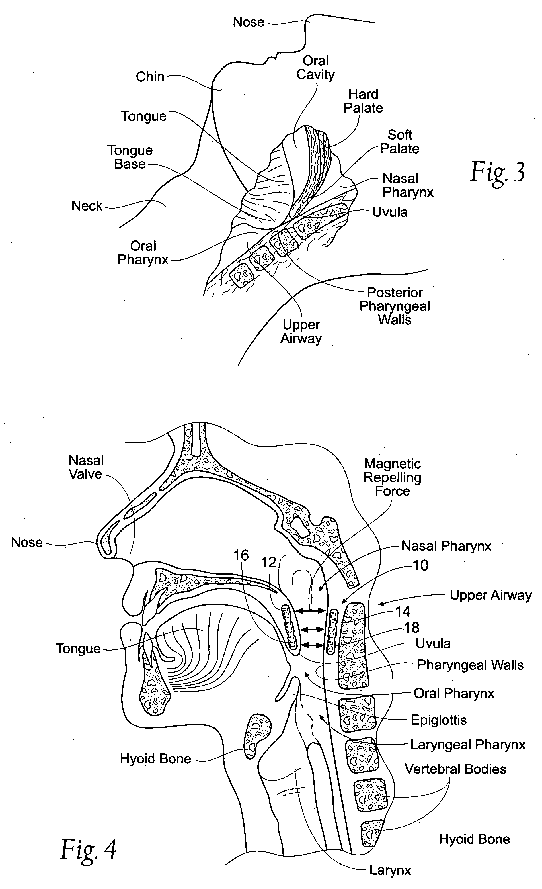 Devices, systems, and methods using magnetic force systems in or on tissue in an airway