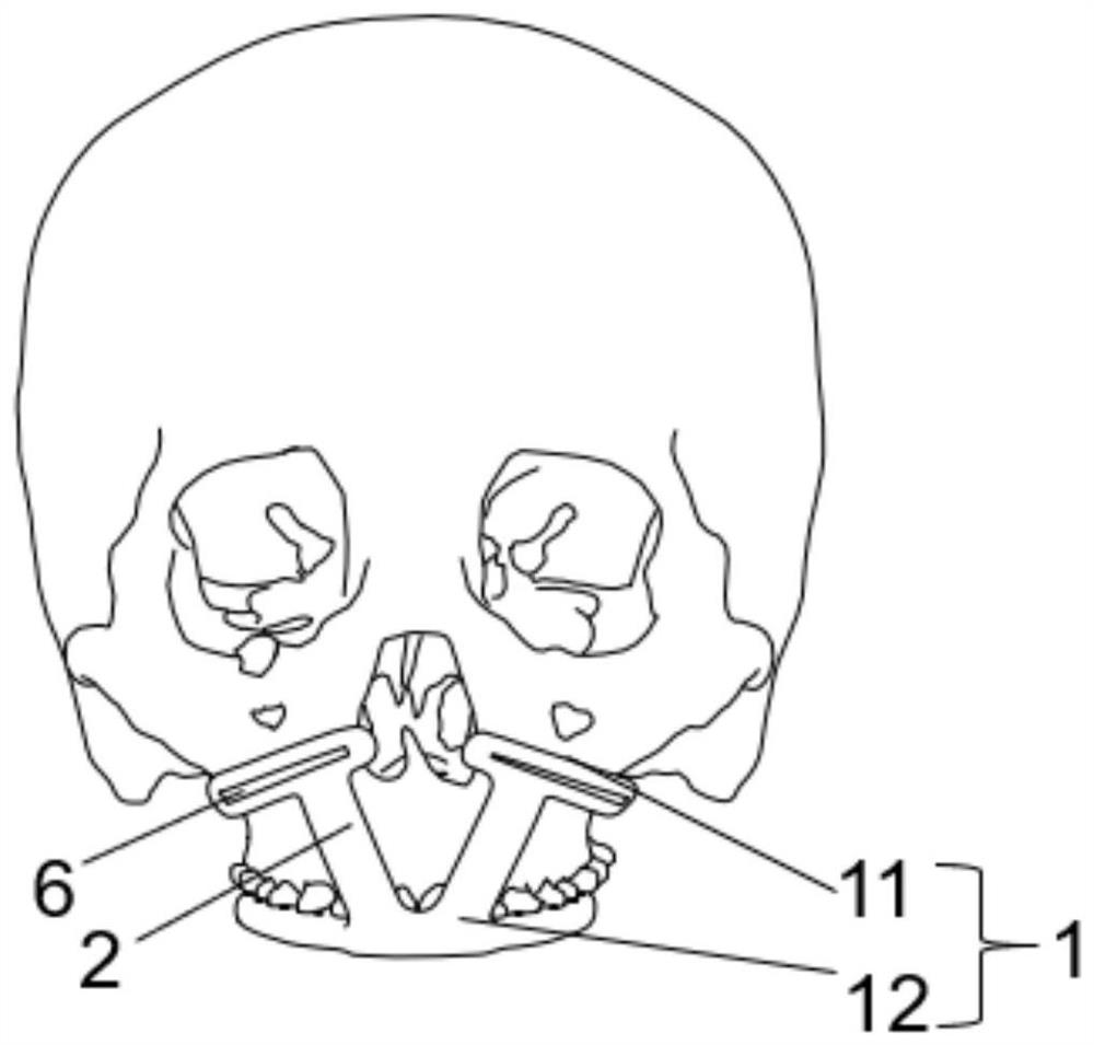 Upper jawbone osteotomy guide plate
