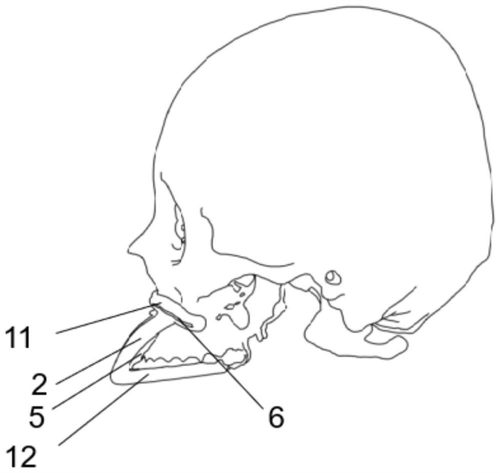 Upper jawbone osteotomy guide plate