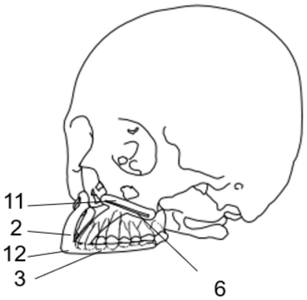 Upper jawbone osteotomy guide plate