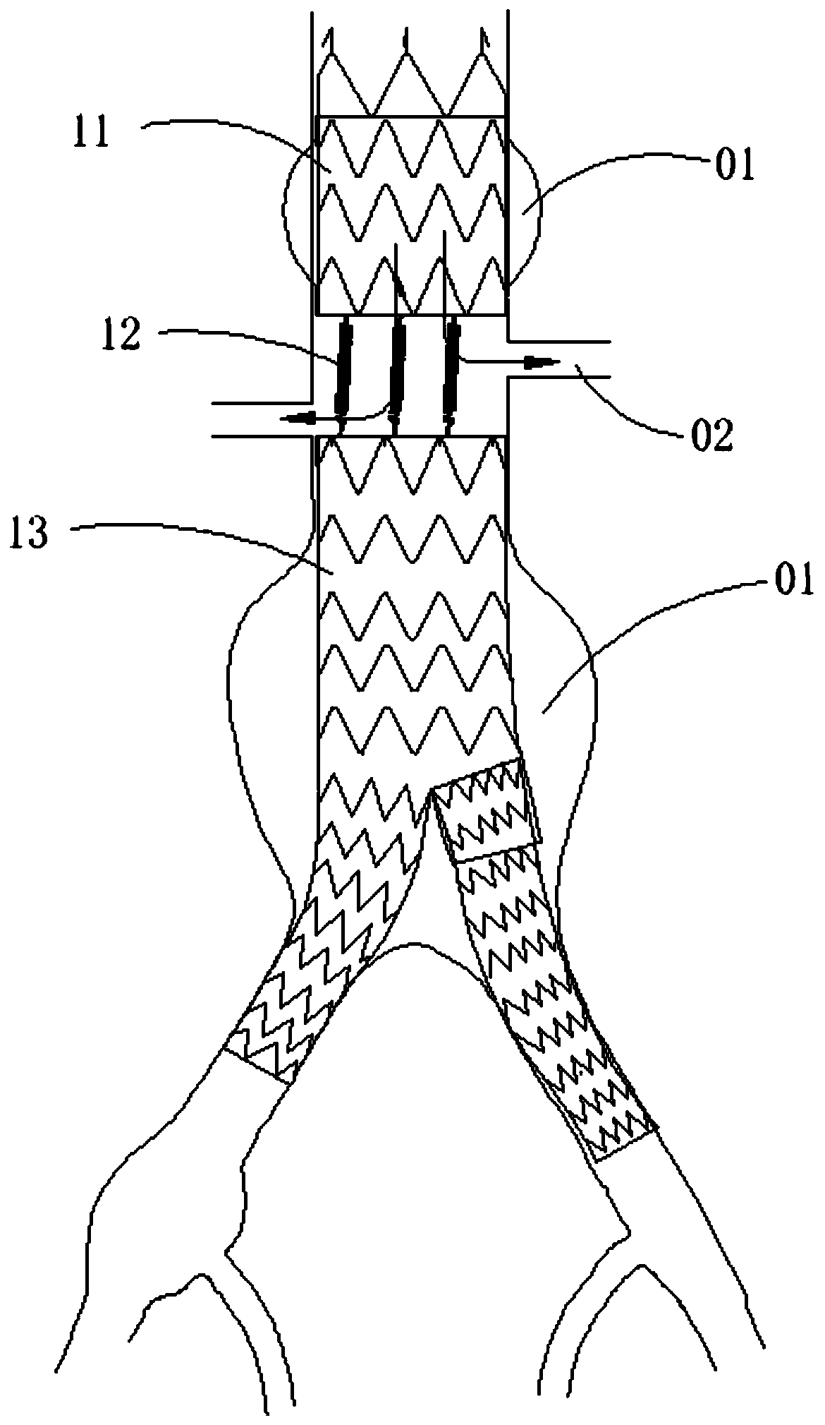 Covered stent