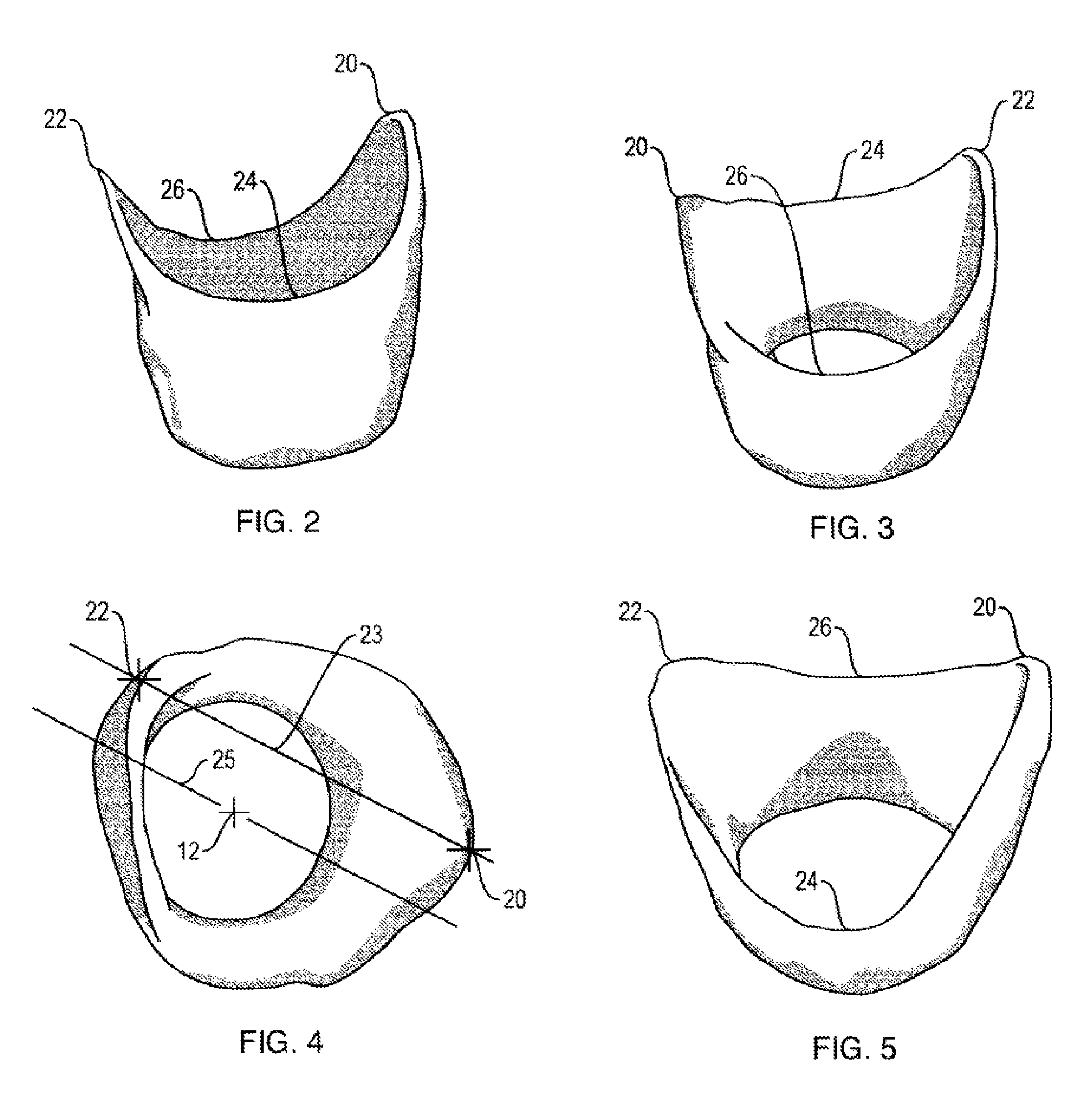 Method and apparatus for recording spatial gingival soft tissue relationship to implant placement within alveolar bone for immediate-implant placement