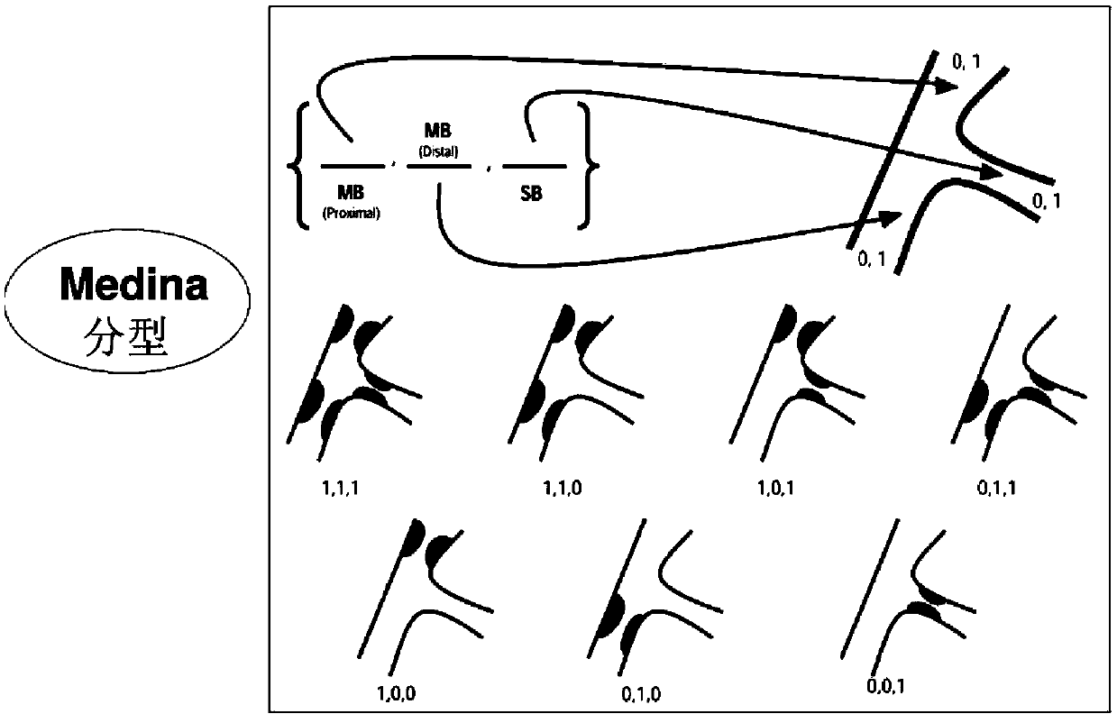 Coronary virtual stent implantation system based on hemodynamic analysis