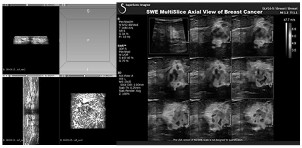 Breast tissue elasticity imaging method, device and equipment and medium