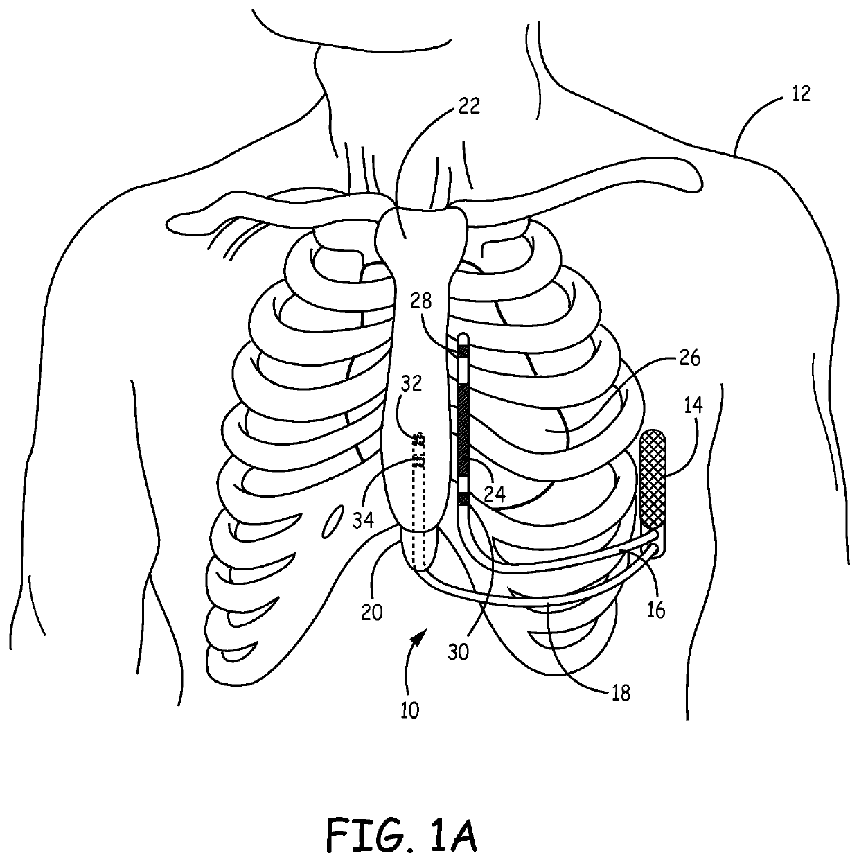 Implantable cardioverter-defibrillator (ICD) system including substernal pacing lead