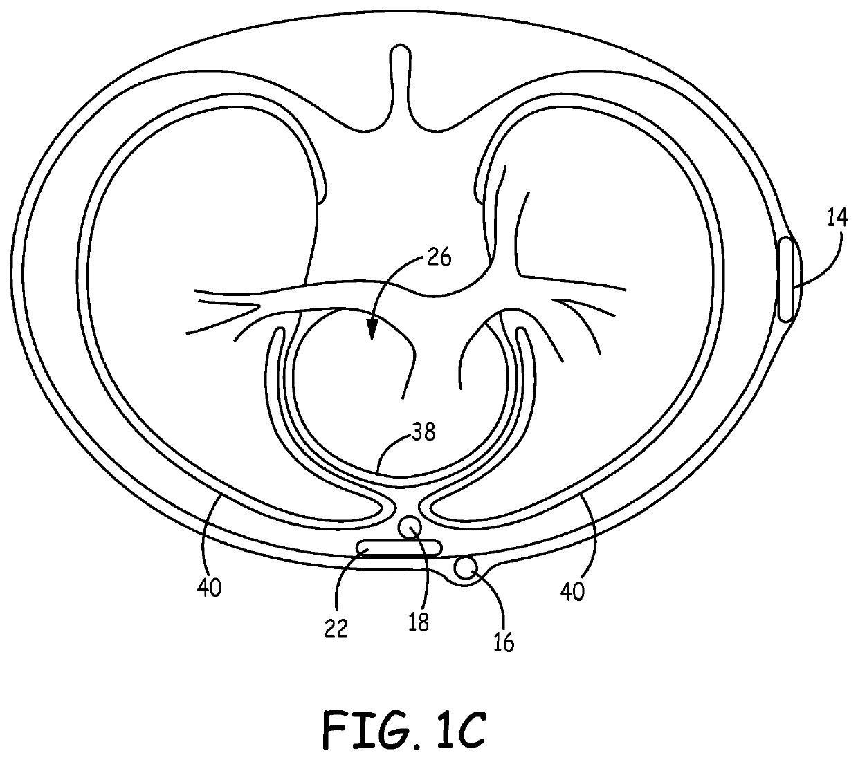 Implantable cardioverter-defibrillator (ICD) system including substernal pacing lead