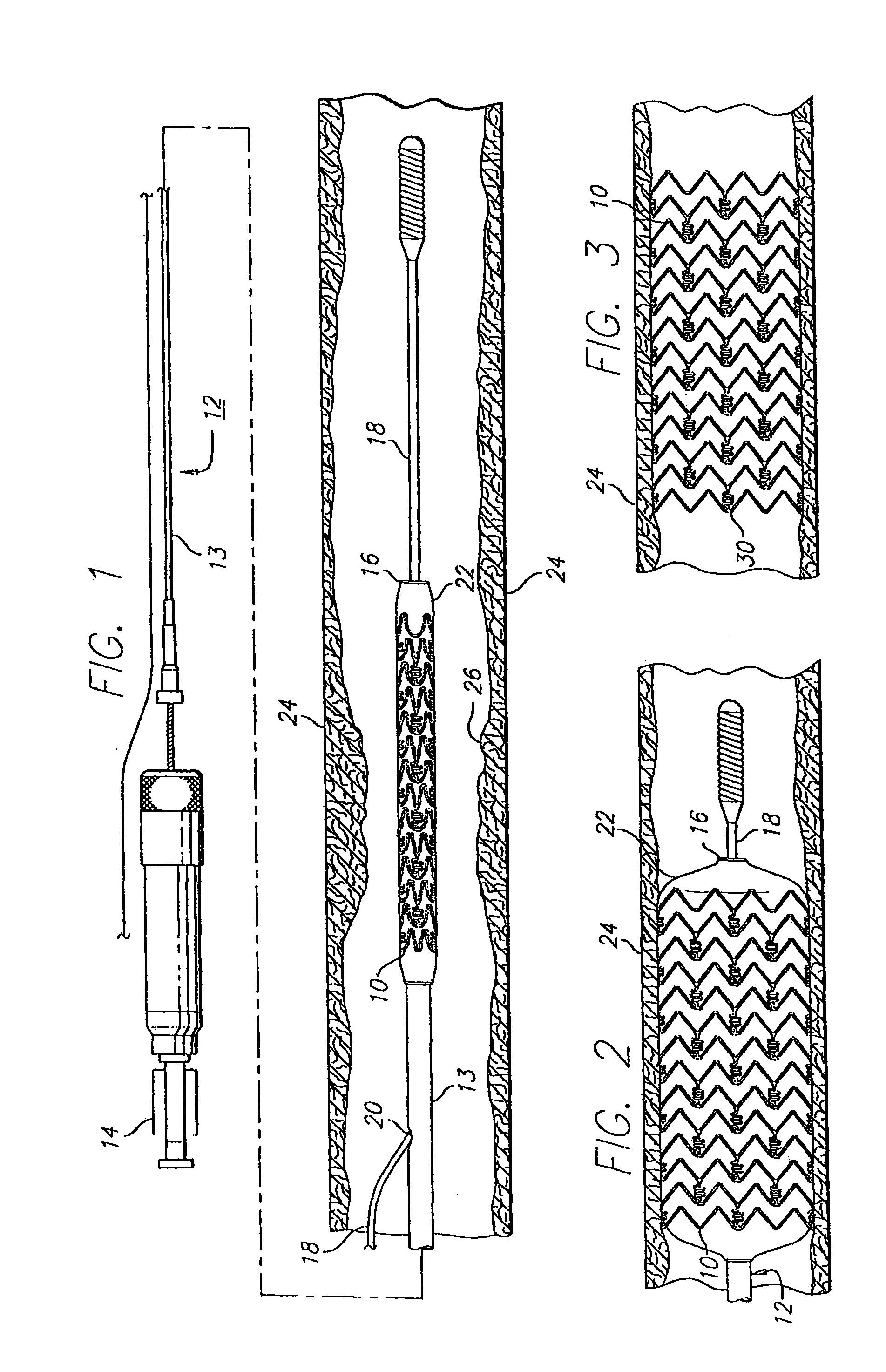 Intravascular stent