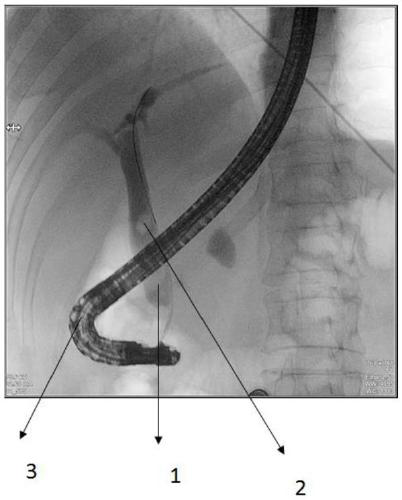 Auxiliary diagnosis and measurement method and system in endoscopic retrograde cholangiopancreatography