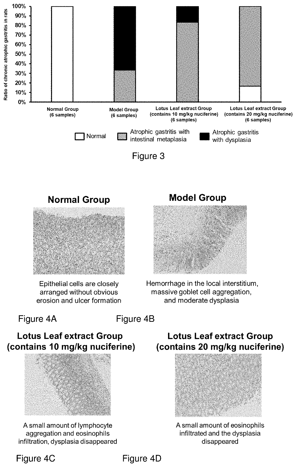 Use of nuciferin and lotus leaf extract in the preparation of a medicament for treating atrophic gastritis and/or blocking transformation  of gastritis into cancer