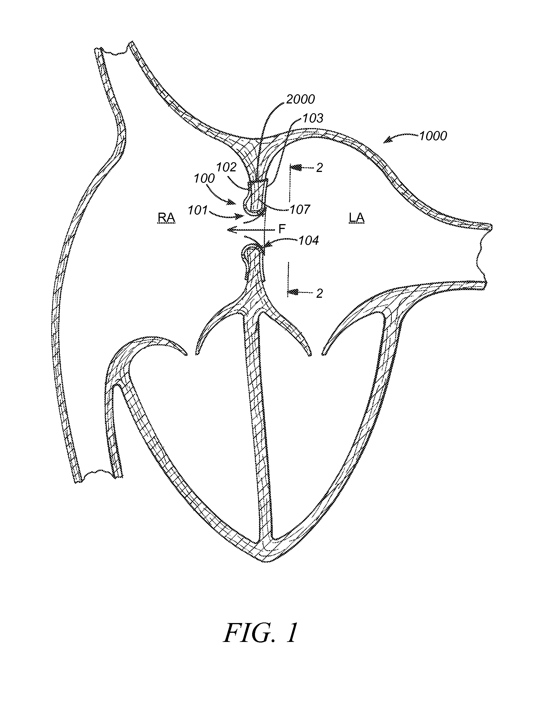 Devices, systems and methods to treat heart failure