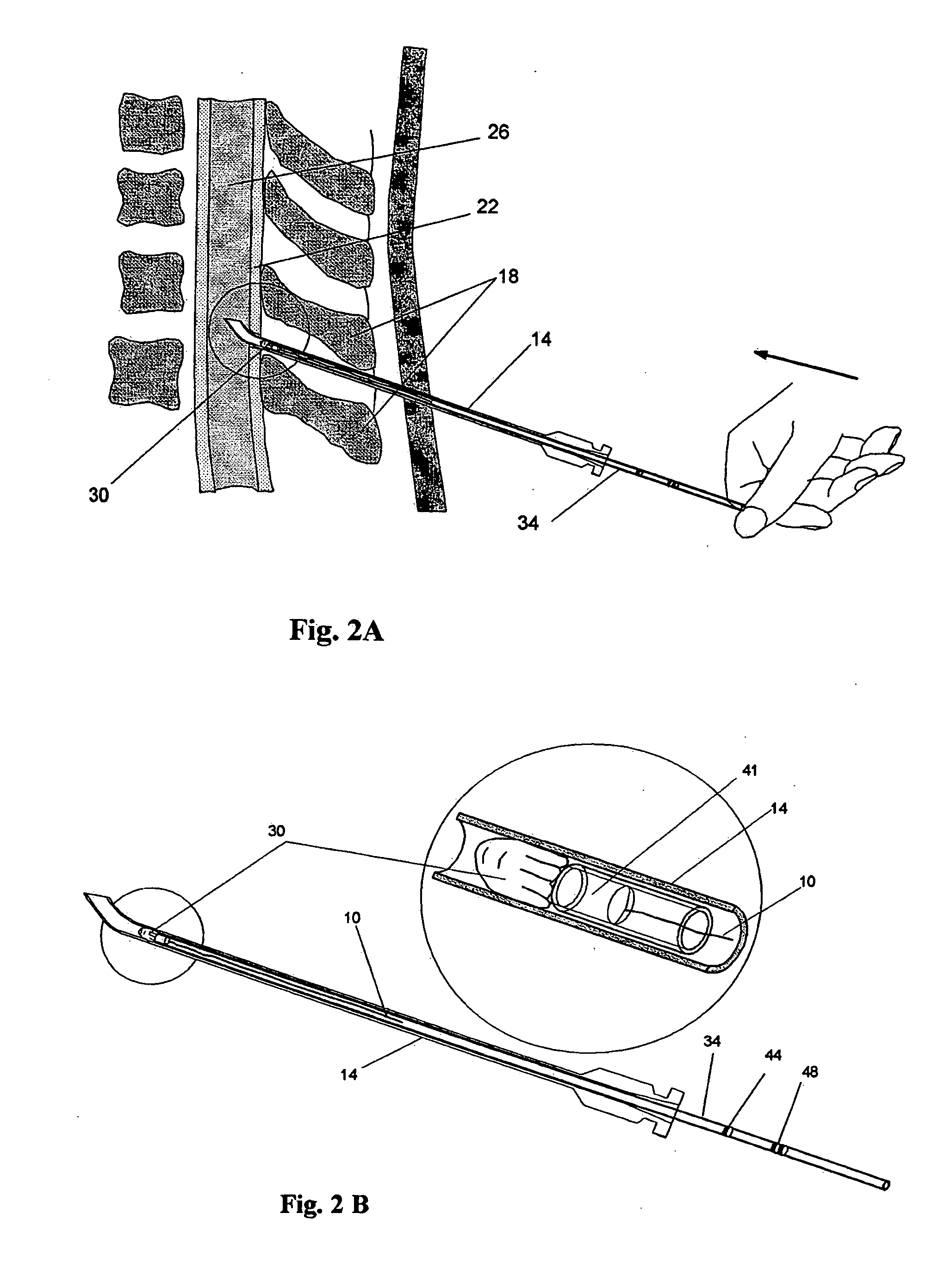 Methods and devices for treating dural puncture