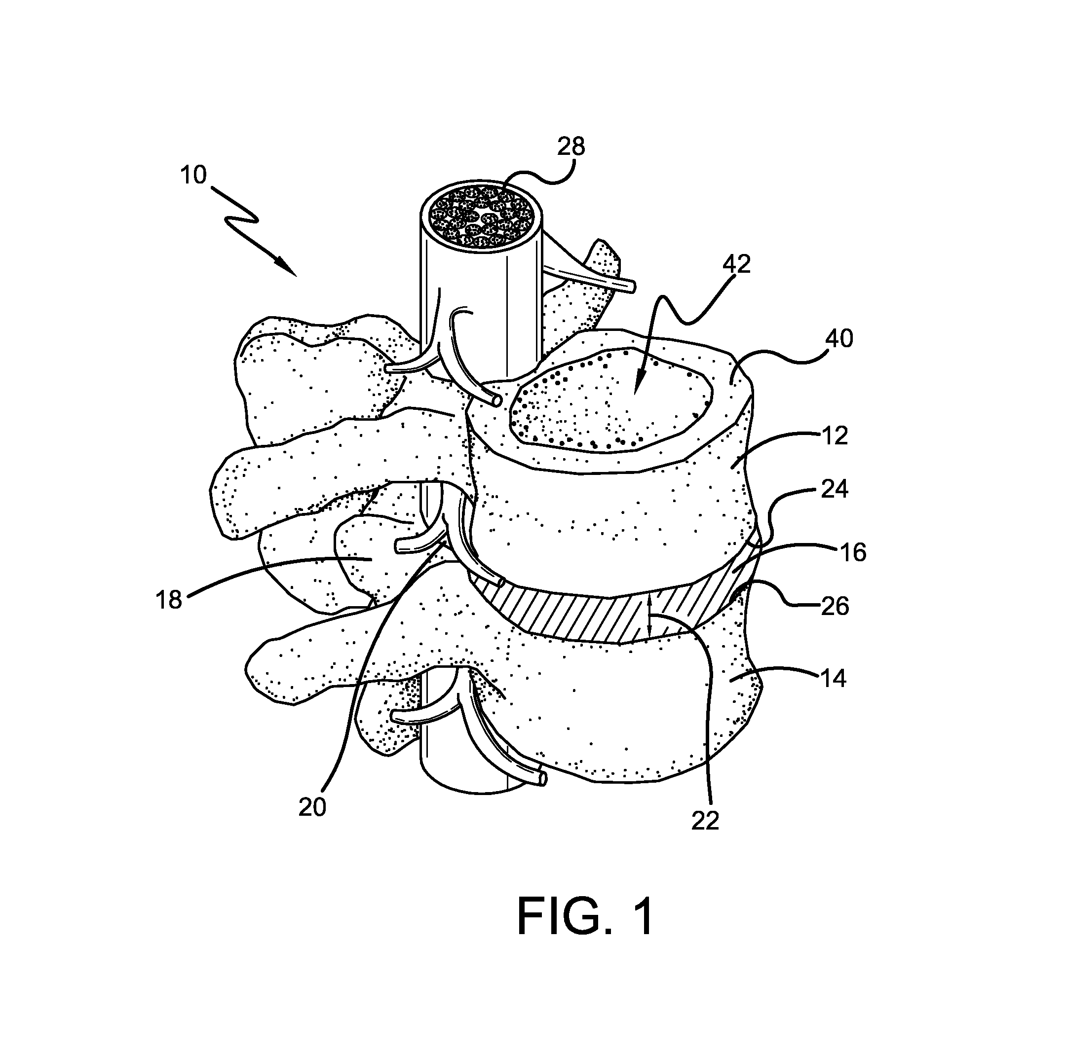 Spine surgery method and implant