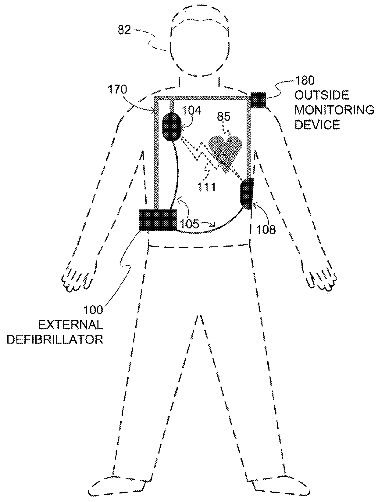 Wearable cardioverter defibrillator (WCD) system evaluating its ECG signals for noise according to tall peak counts