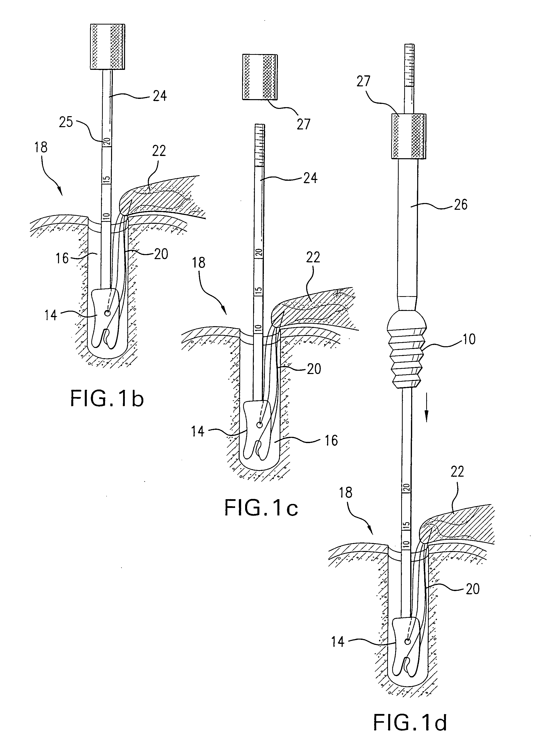 Method and device for securing sutures to bones