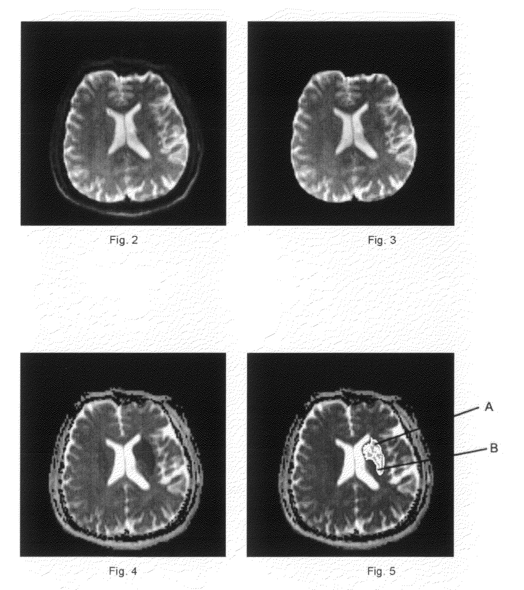 Methods and devices for producing the parameters of the brain tissues and assessing data of the suitability for thrombolysis of a patient