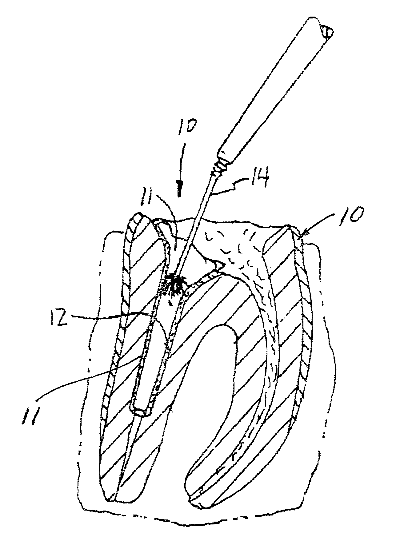 Contact cure dental post cement and method of placing a dental post