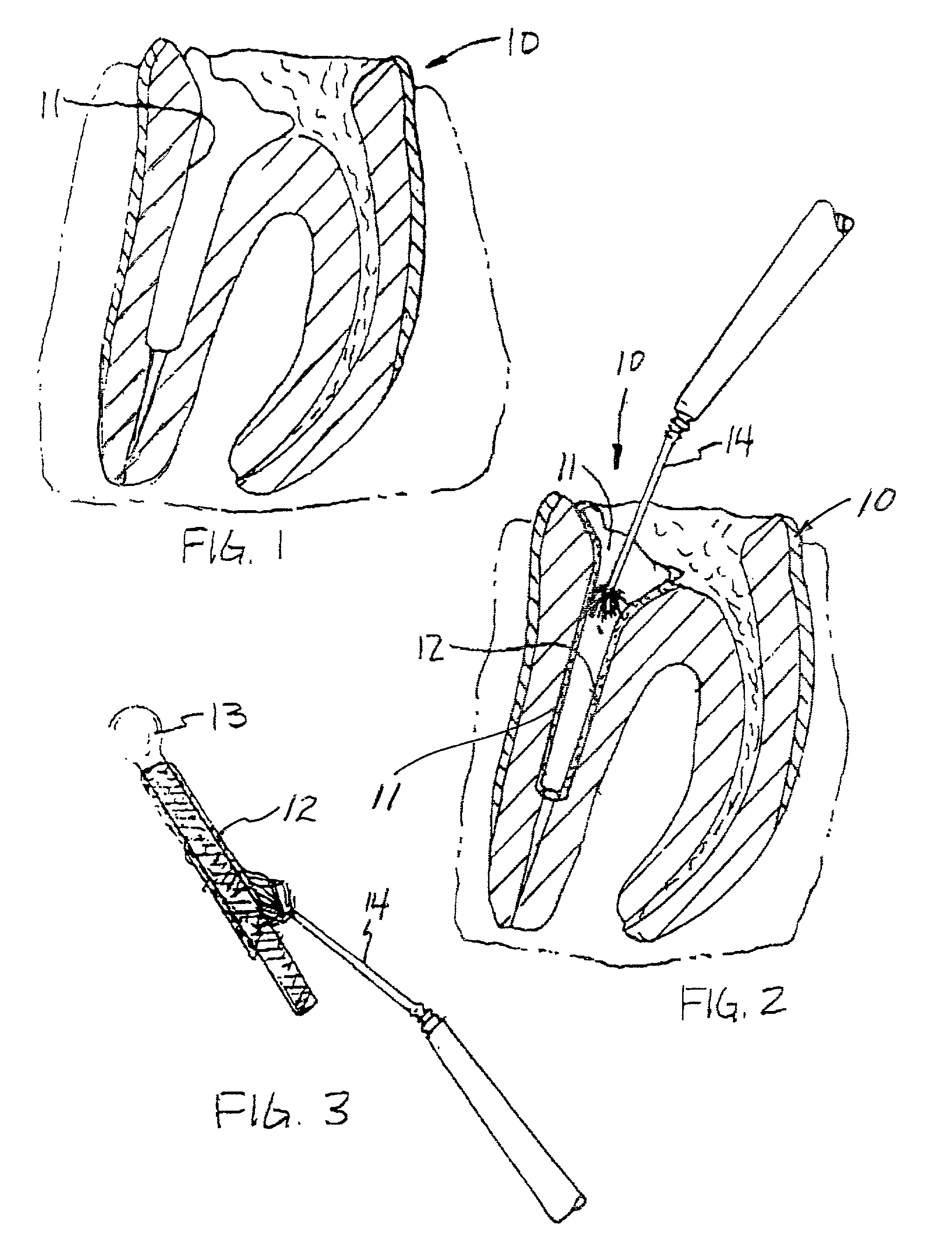 Contact cure dental post cement and method of placing a dental post