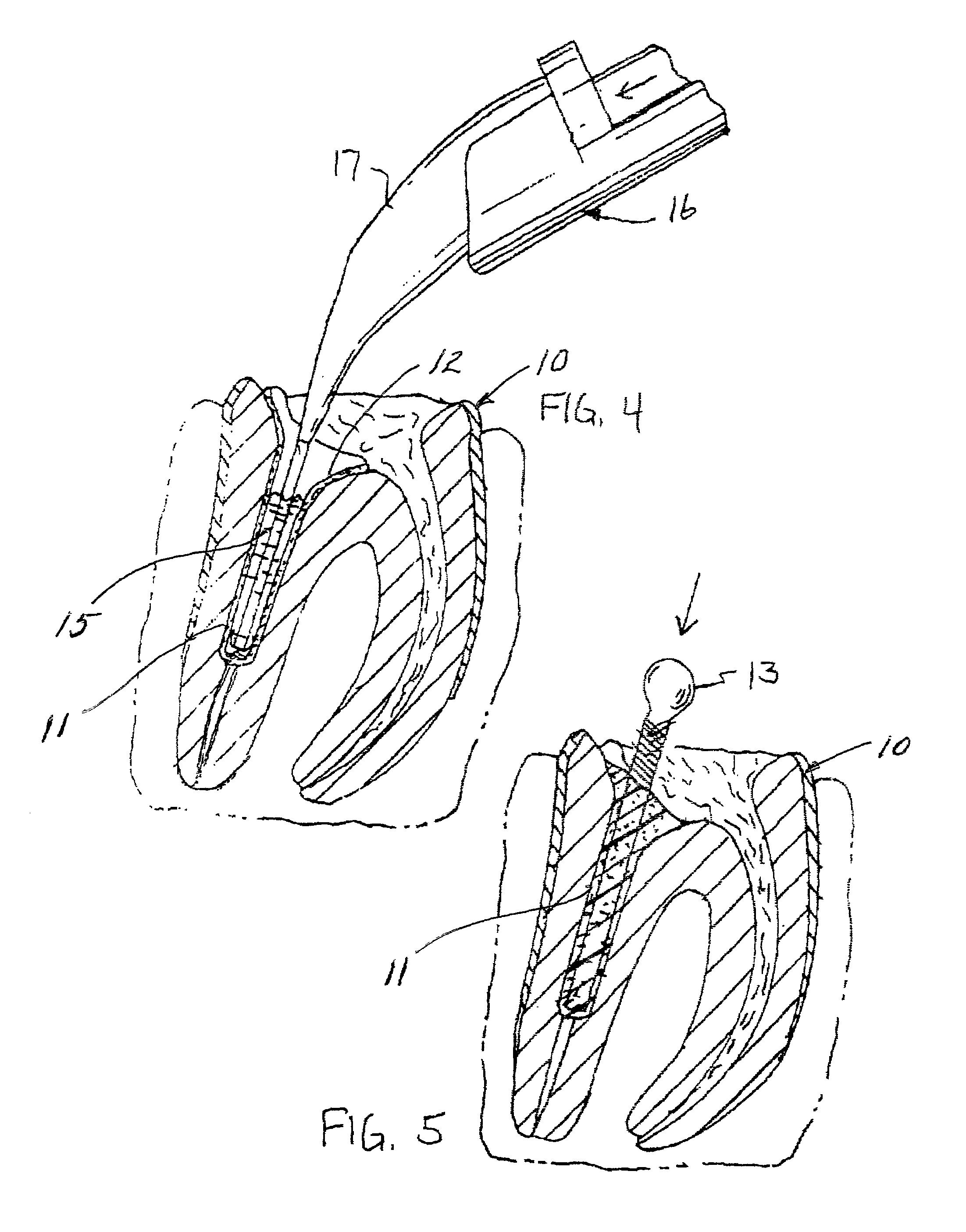 Contact cure dental post cement and method of placing a dental post