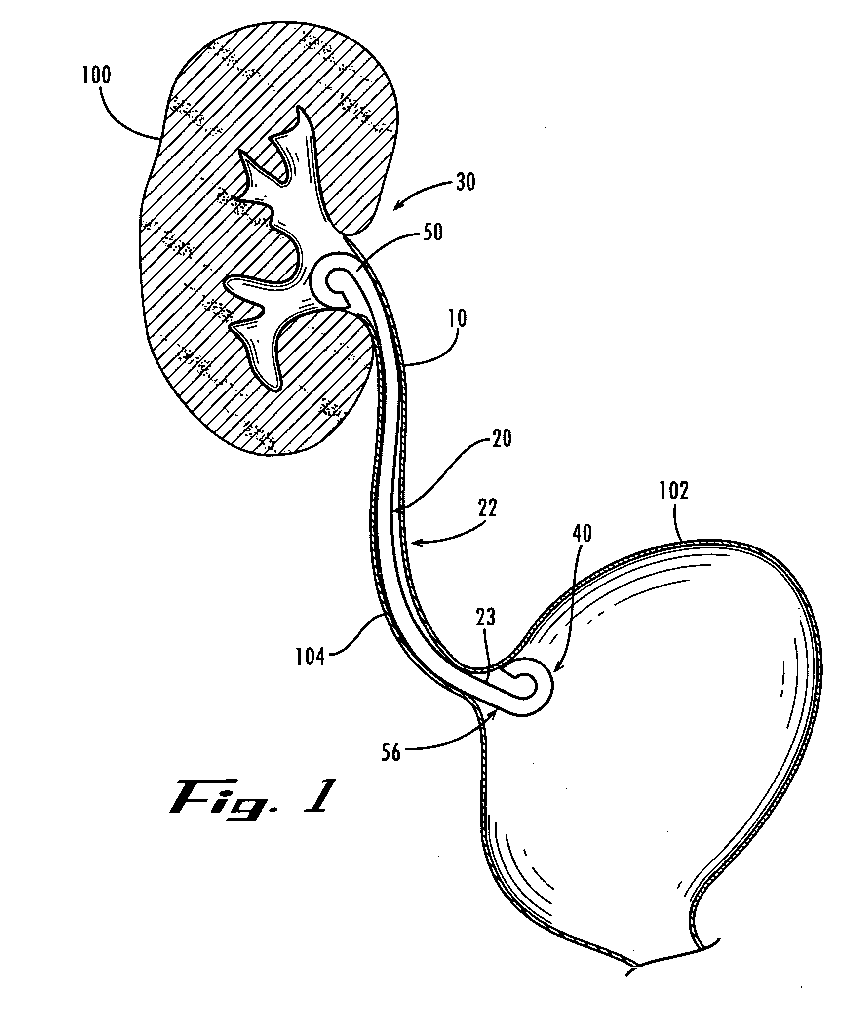 Stent with flexible elements