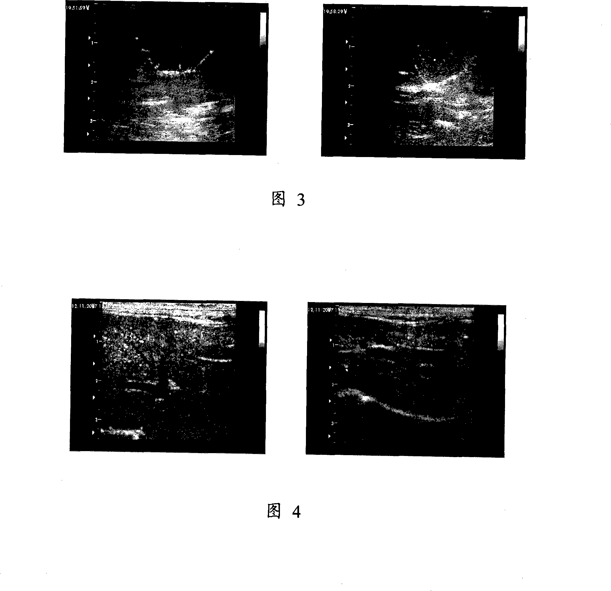 System for positioning delivery of medicament and quantitatively controlling and releasing